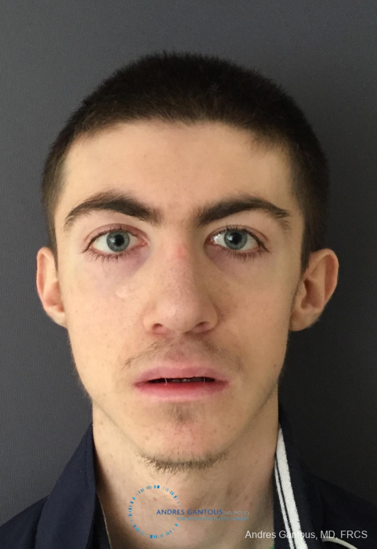 Rhinoplasty: Patient 78 - After 
