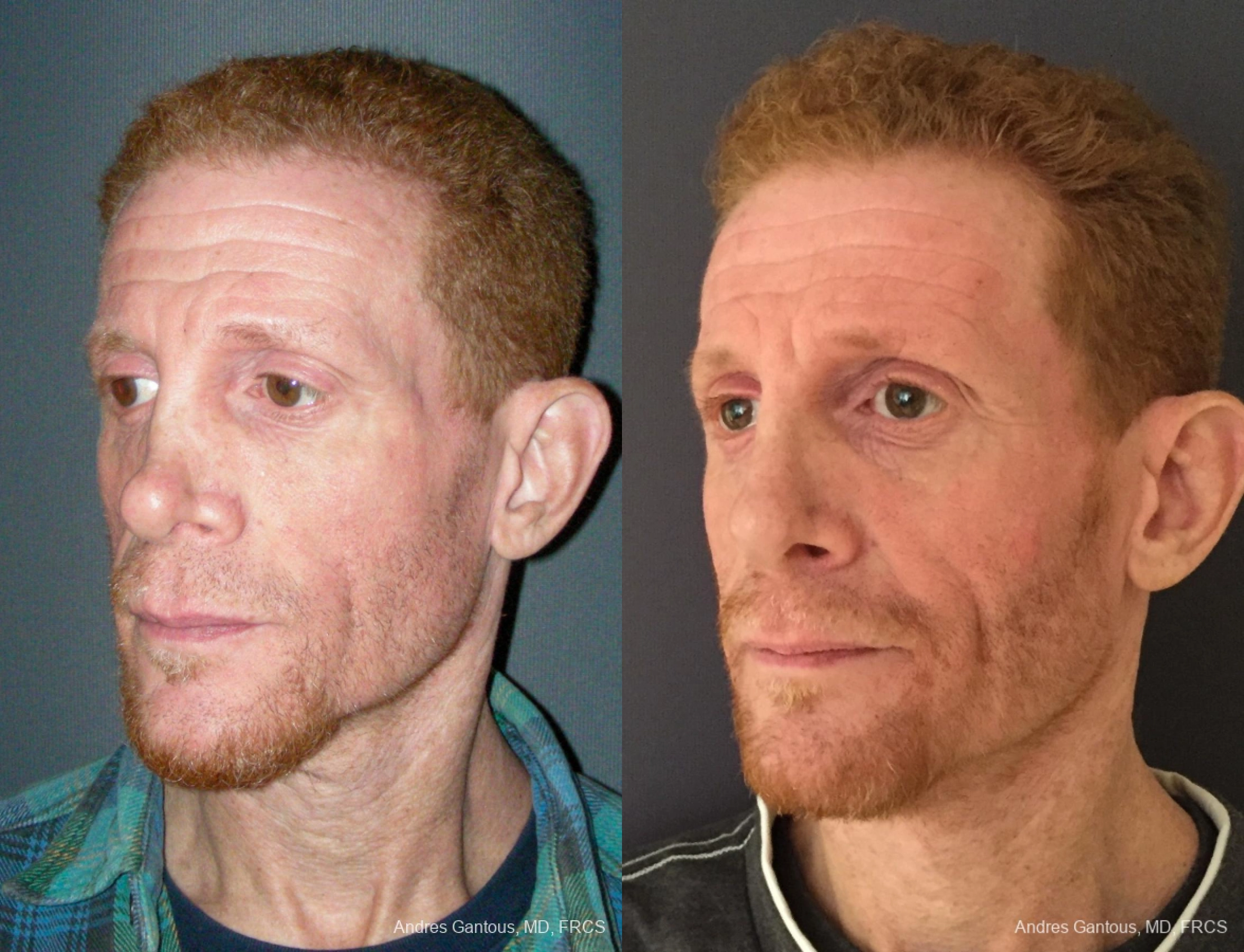 Reconstructive Rhinoplasty - Thumbnail 2