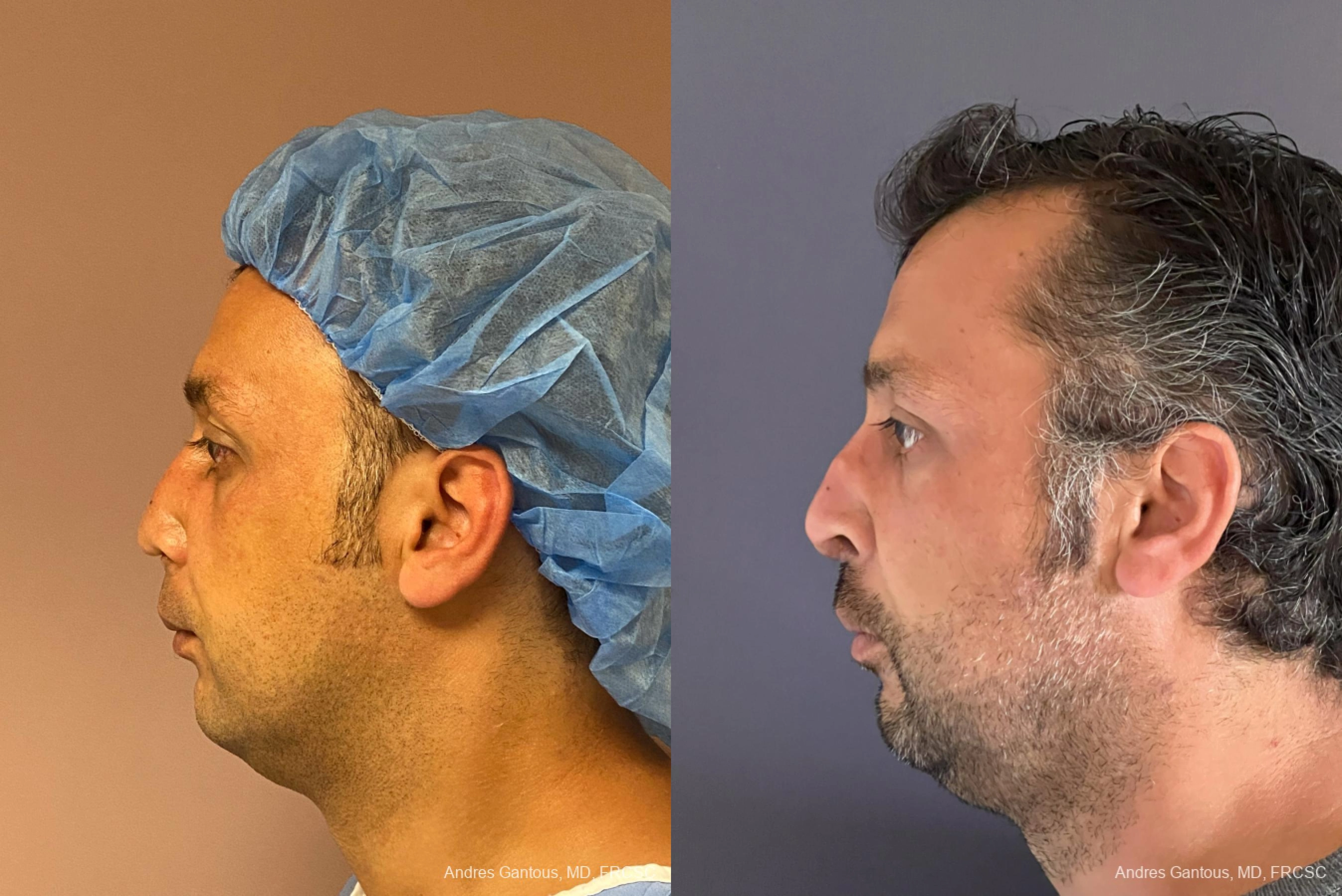Reconstructive Rhinoplasty - Thumbnail 6