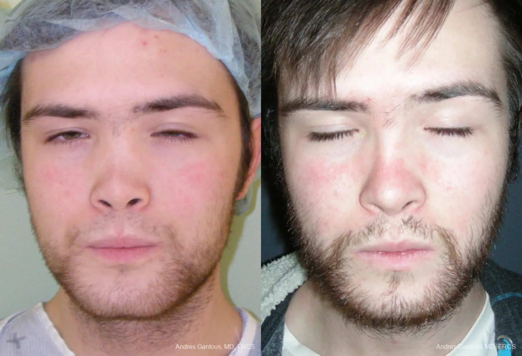 Reconstructive Rhinoplasty: Patient 8 - Before and After  