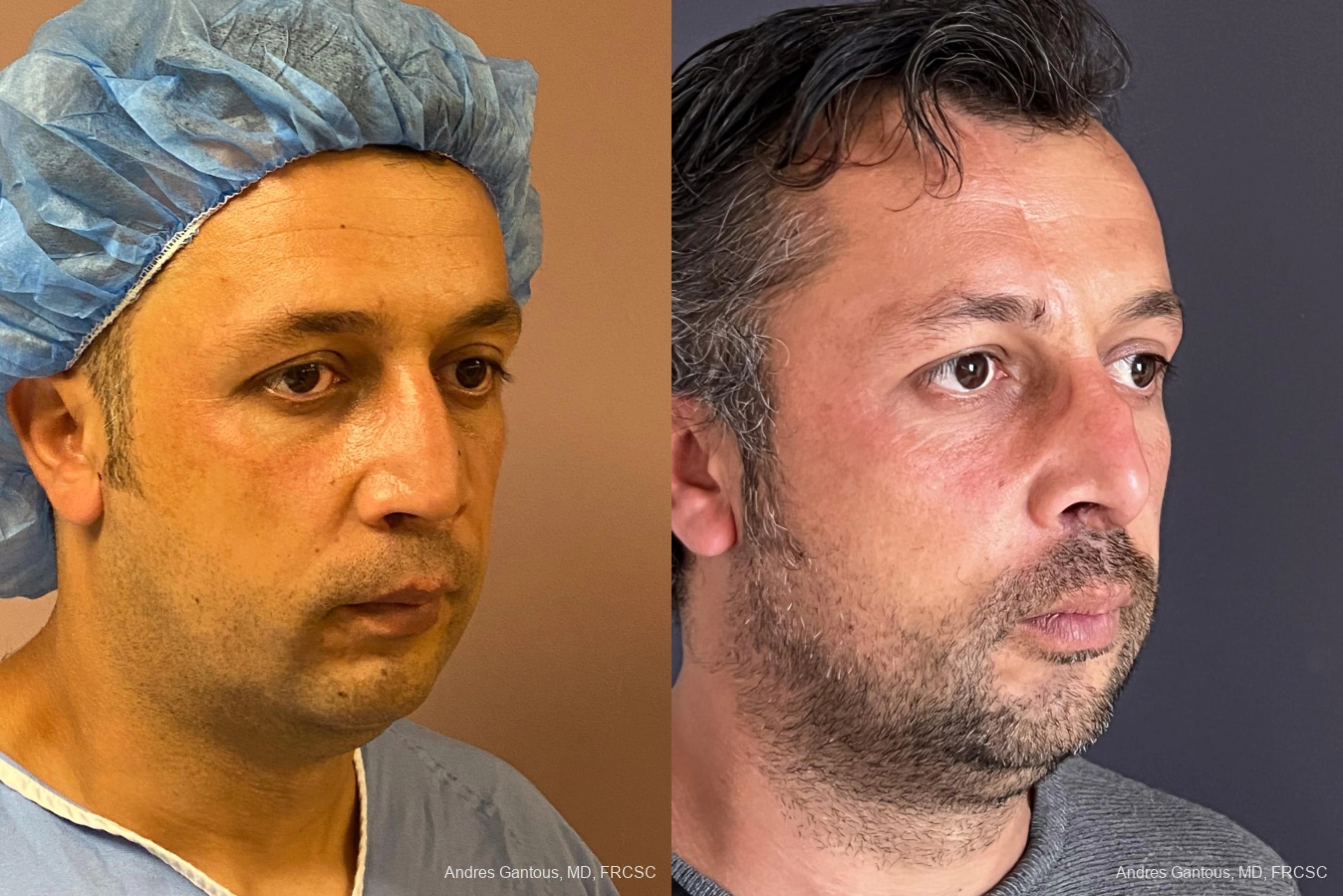 Reconstructive Rhinoplasty - Thumbnail 3