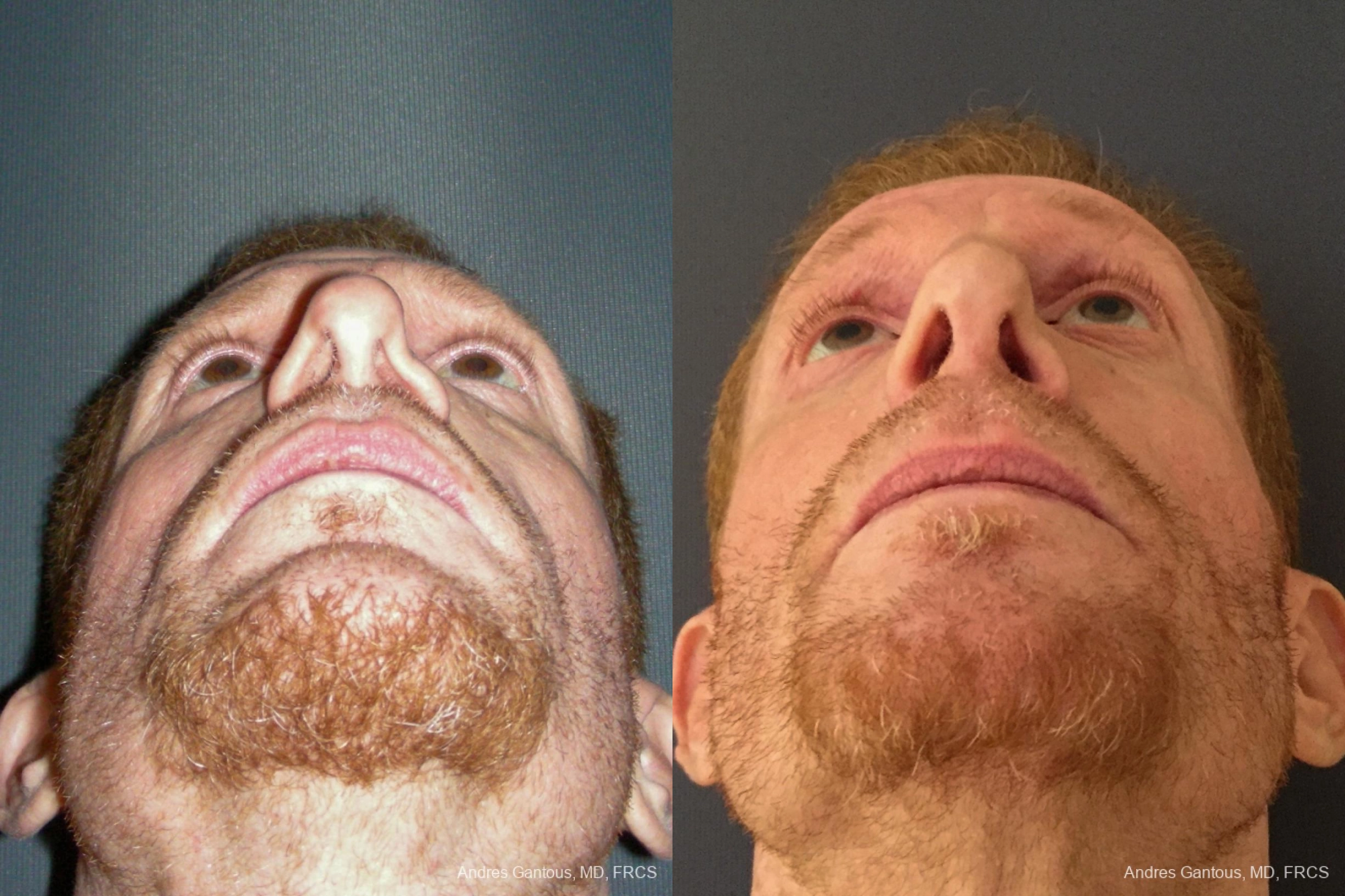 Reconstructive Rhinoplasty - Thumbnail 6