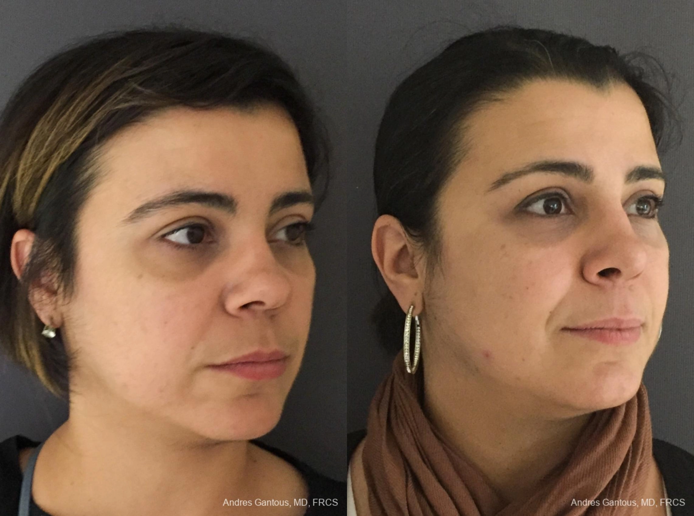 Reconstructive Rhinoplasty - Thumbnail 3