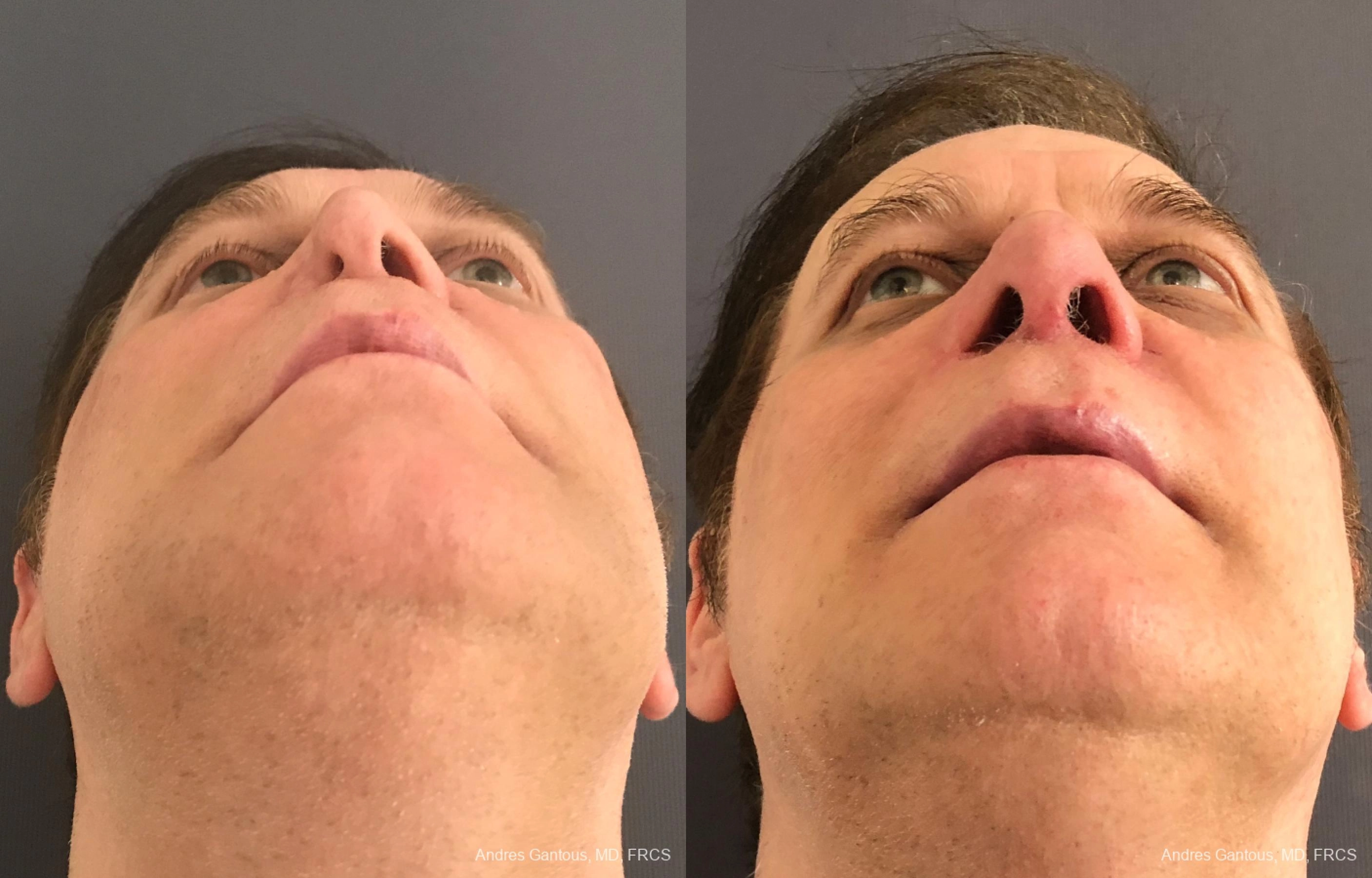Reconstructive Rhinoplasty - Thumbnail 5