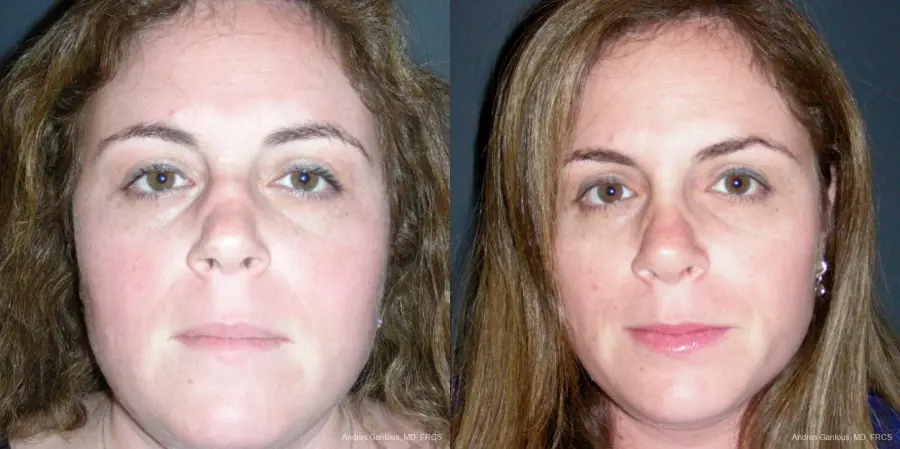 Reconstructive Rhinoplasty: Patient 4 - Before and After  