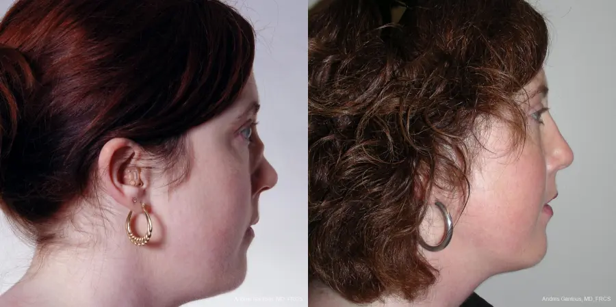 Reconstructive Rhinoplasty: Patient 2 - Before and After 5