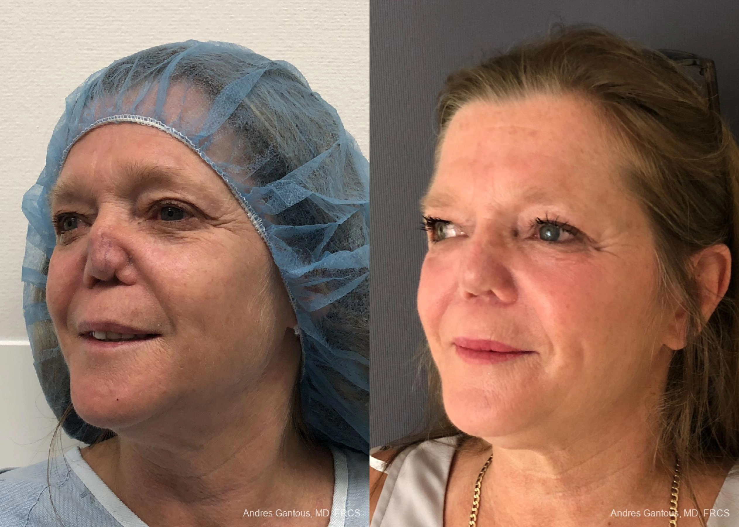 Reconstructive Rhinoplasty - Thumbnail 2