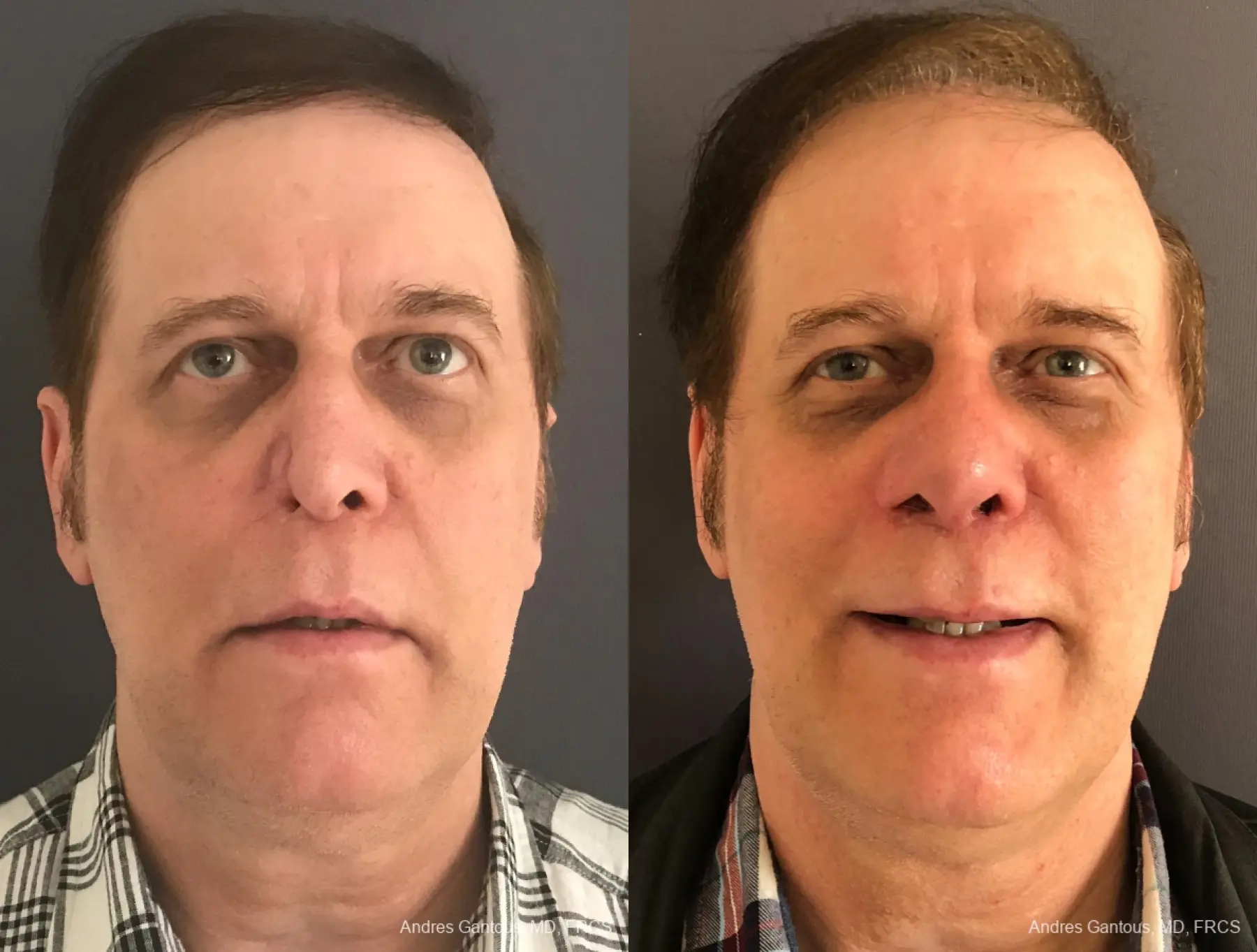 Reconstructive Rhinoplasty: Patient 6 - Before and After  