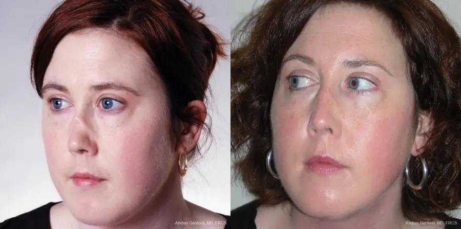 Reconstructive Rhinoplasty: Patient 2 - Before and After 2