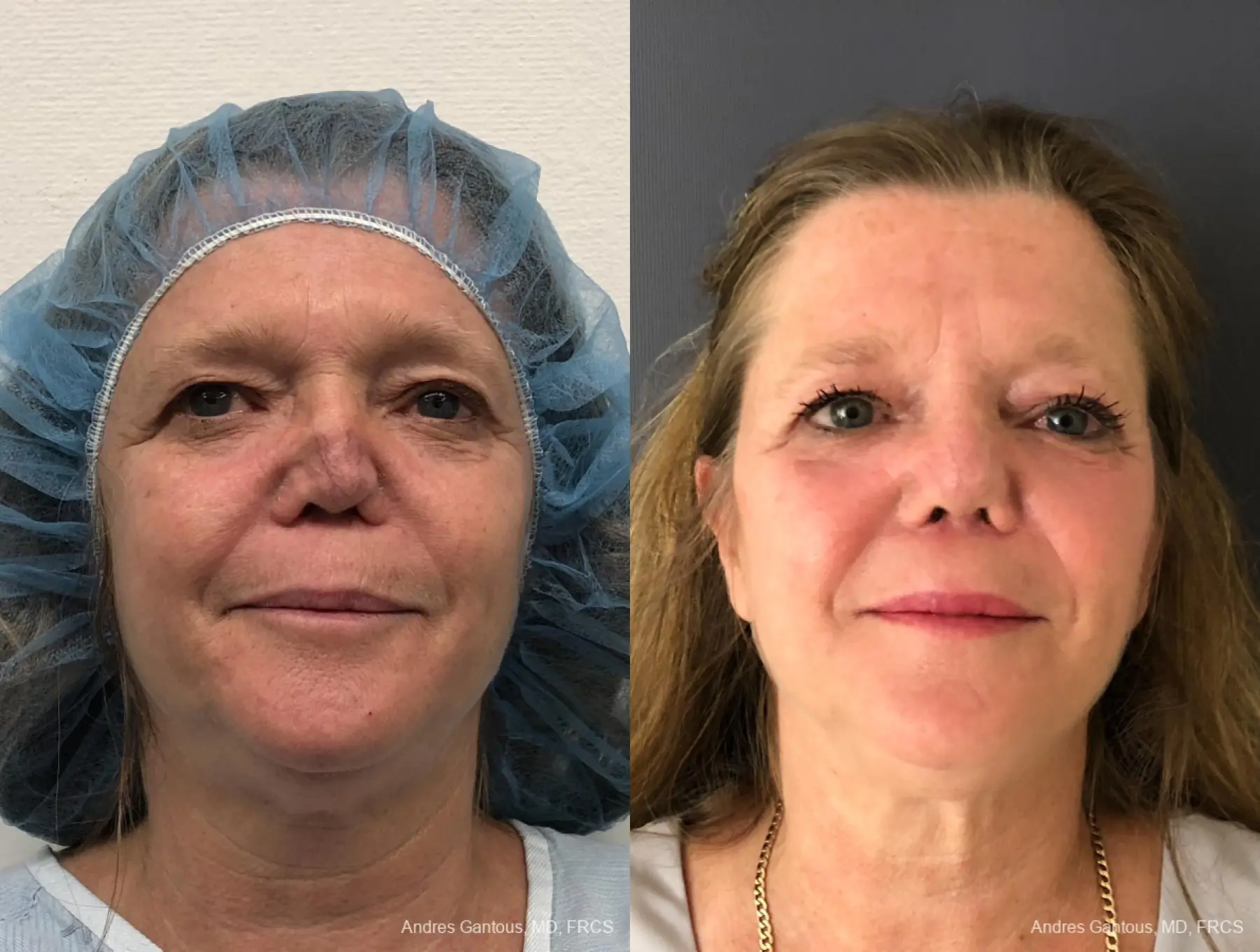 Reconstructive Rhinoplasty: Patient 9 - Before and After  