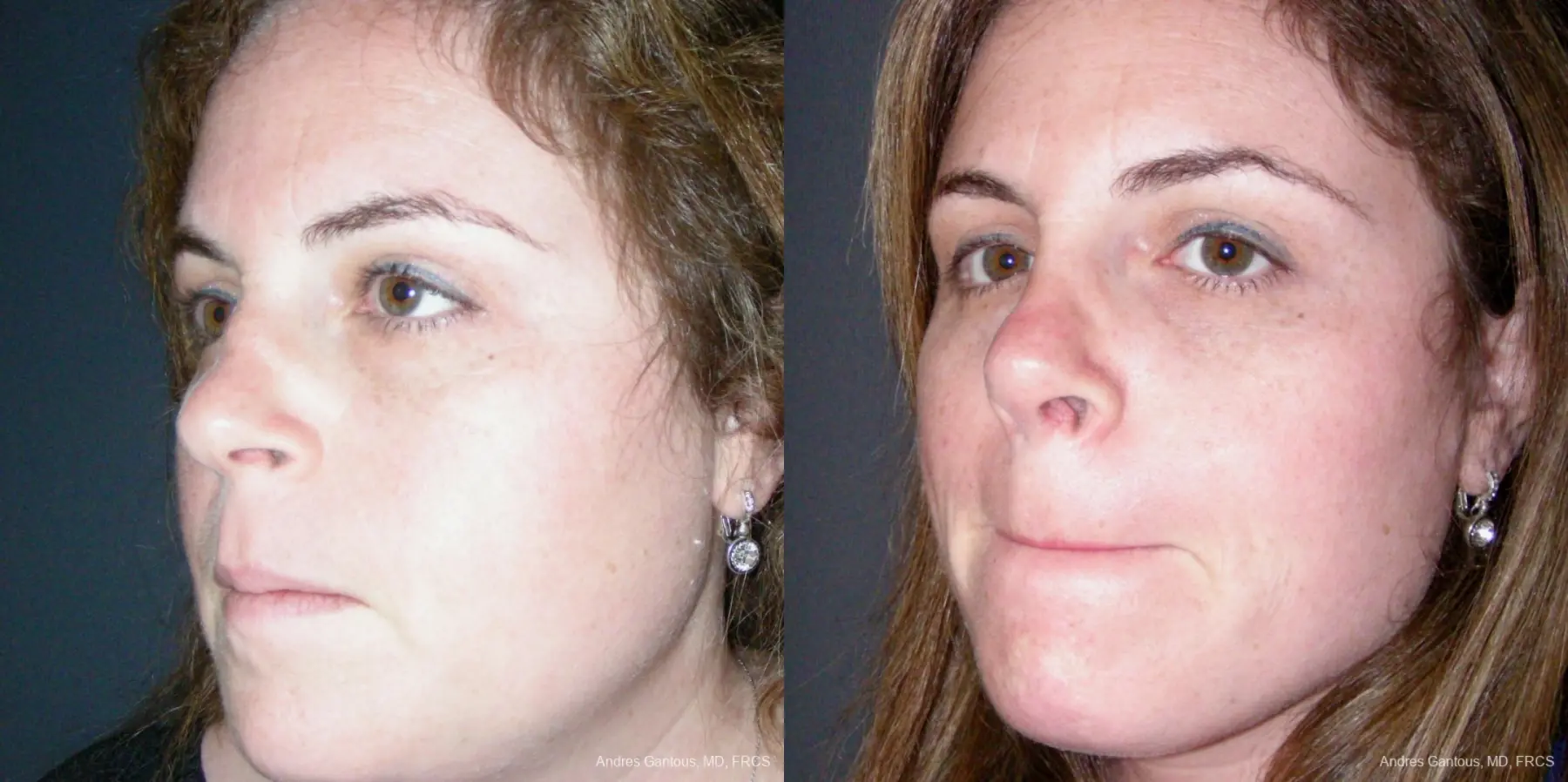 Reconstructive Rhinoplasty: Patient 4 - Before and After 4