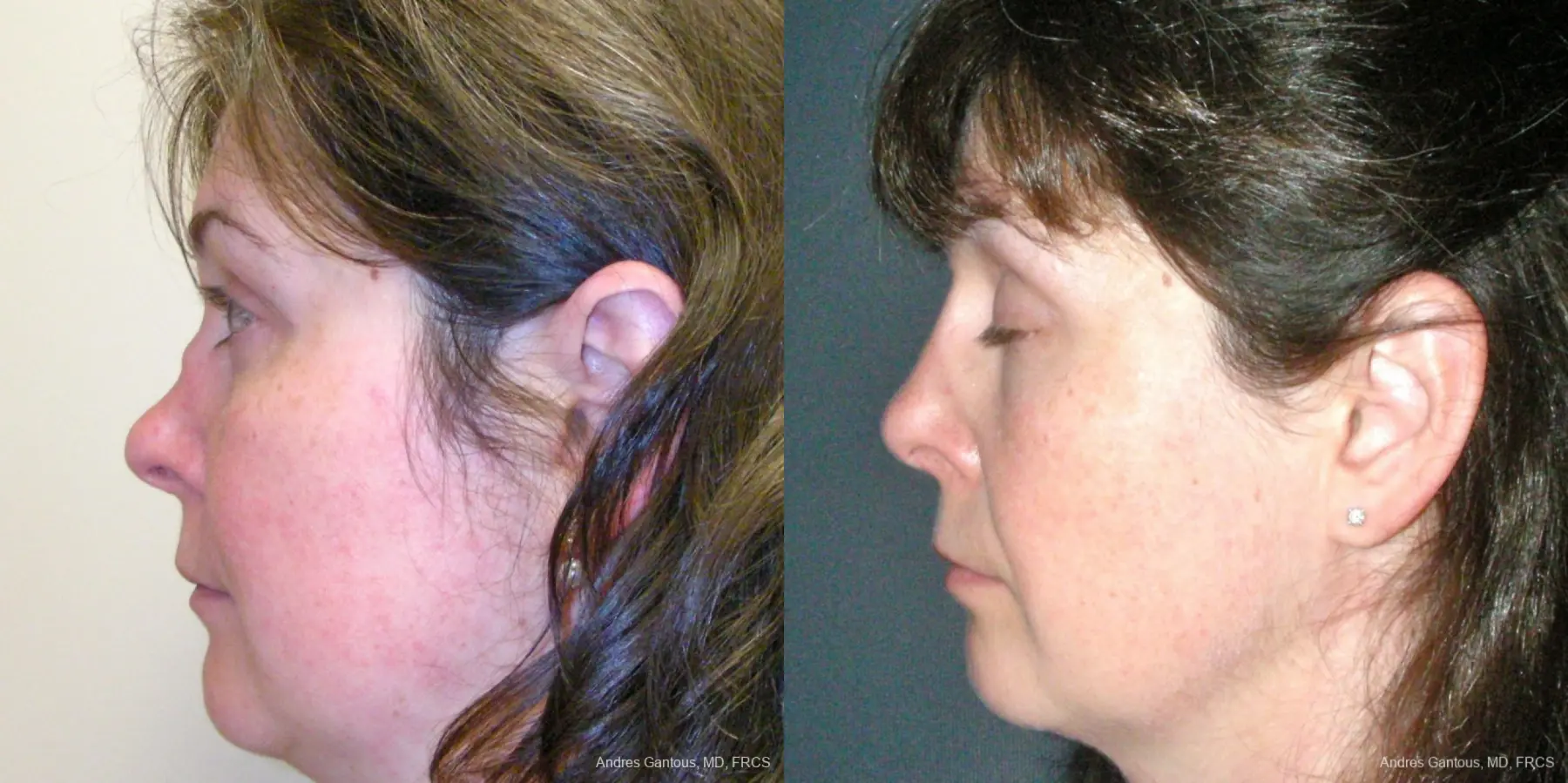 Reconstructive Rhinoplasty: Patient 5 - Before and After 5