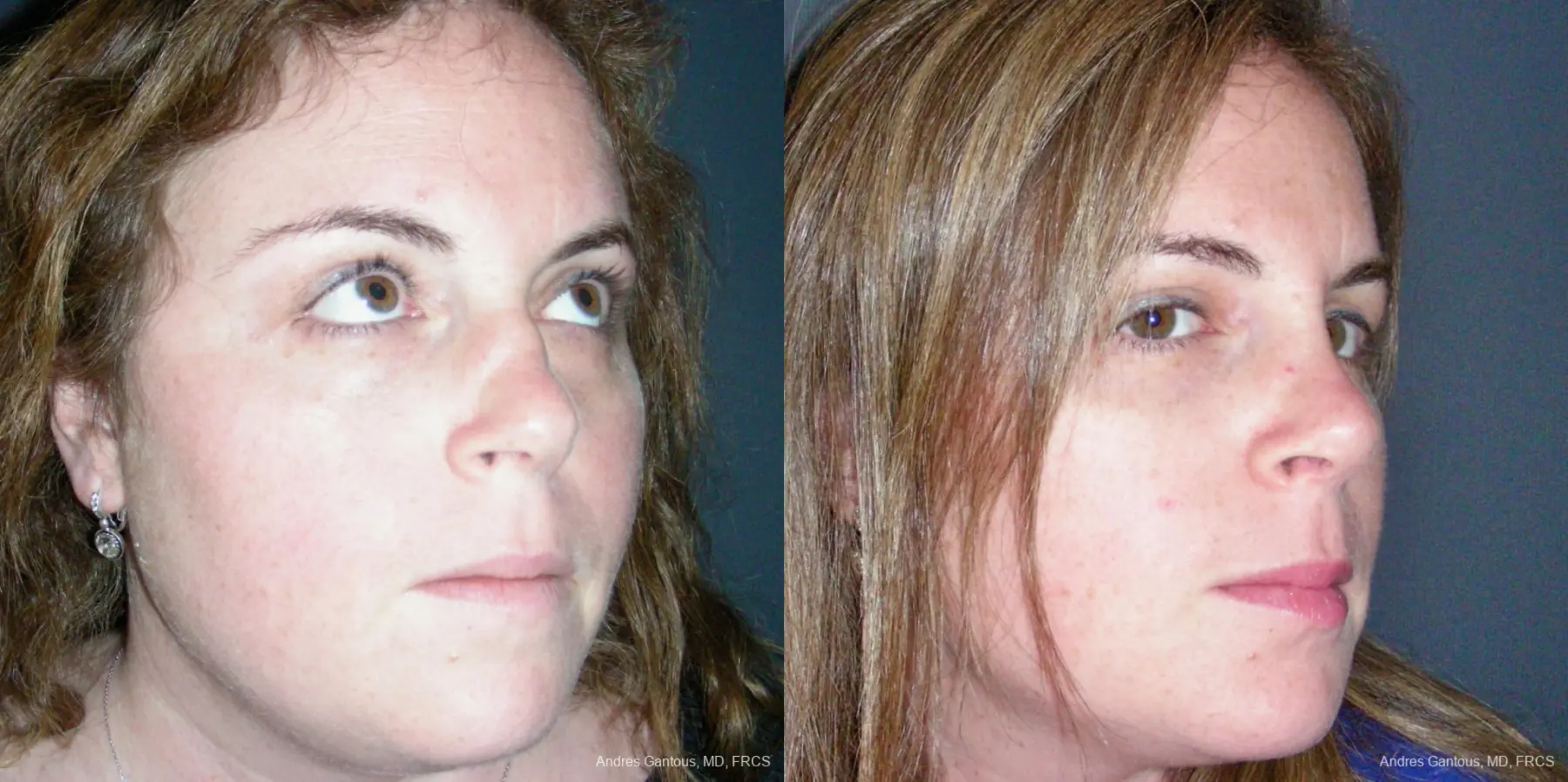 Reconstructive Rhinoplasty: Patient 4 - Before and After 2