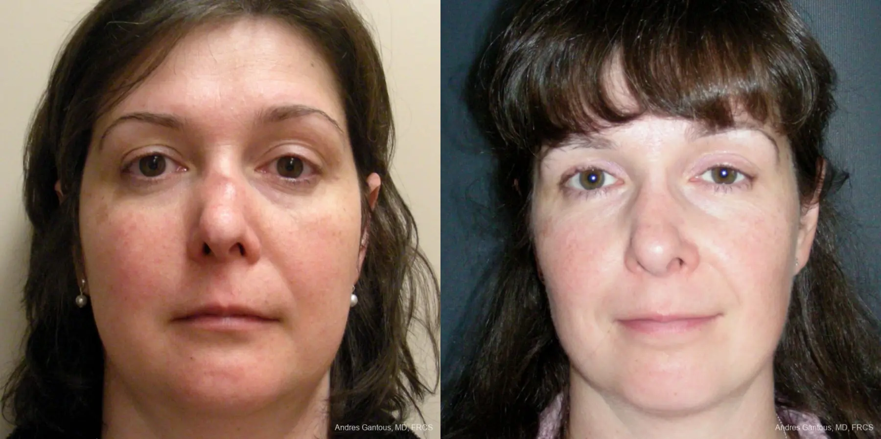 Reconstructive Rhinoplasty: Patient 5 - Before and After  