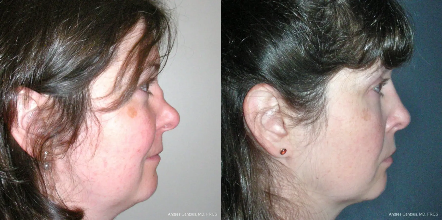 Reconstructive Rhinoplasty: Patient 5 - Before and After 3