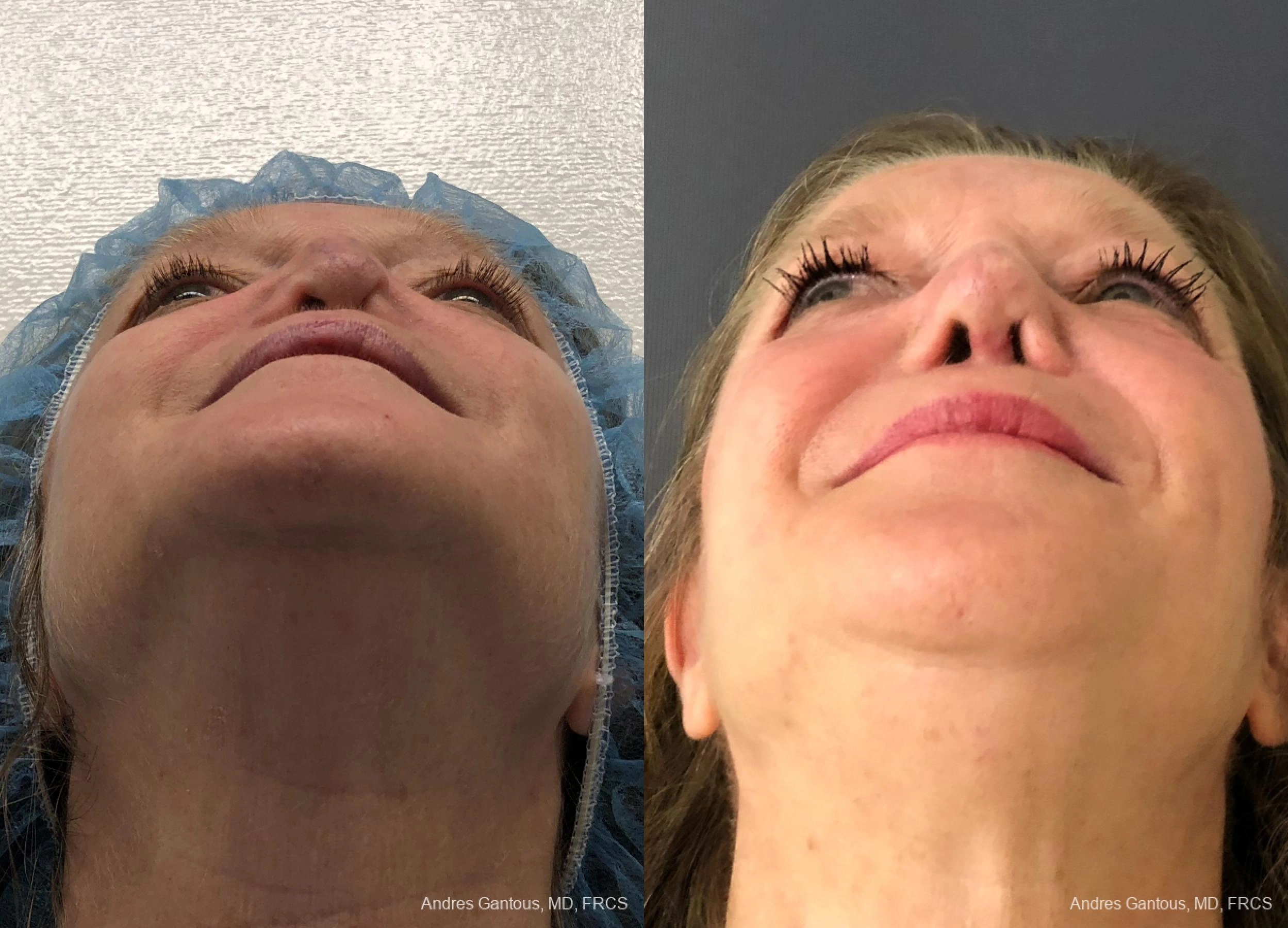 Reconstructive Rhinoplasty - Thumbnail 5