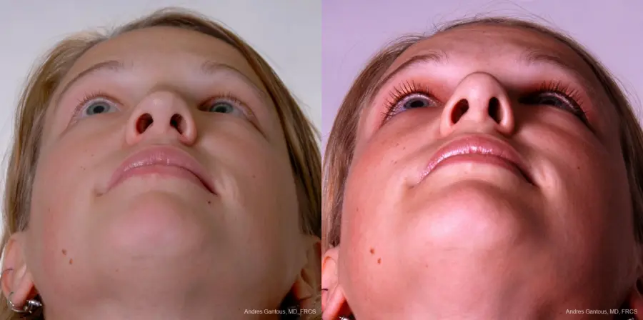 Reconstructive Rhinoplasty: Patient 3 - Before and After 2
