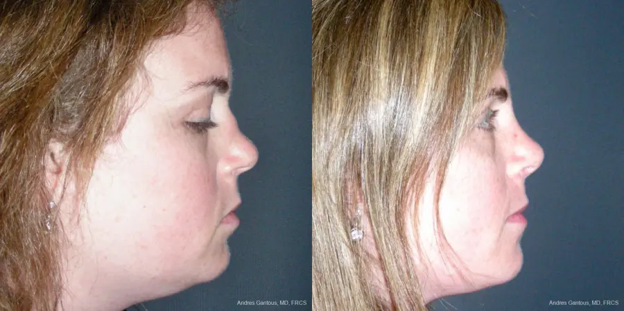 Reconstructive Rhinoplasty: Patient 4 - Before and After 3