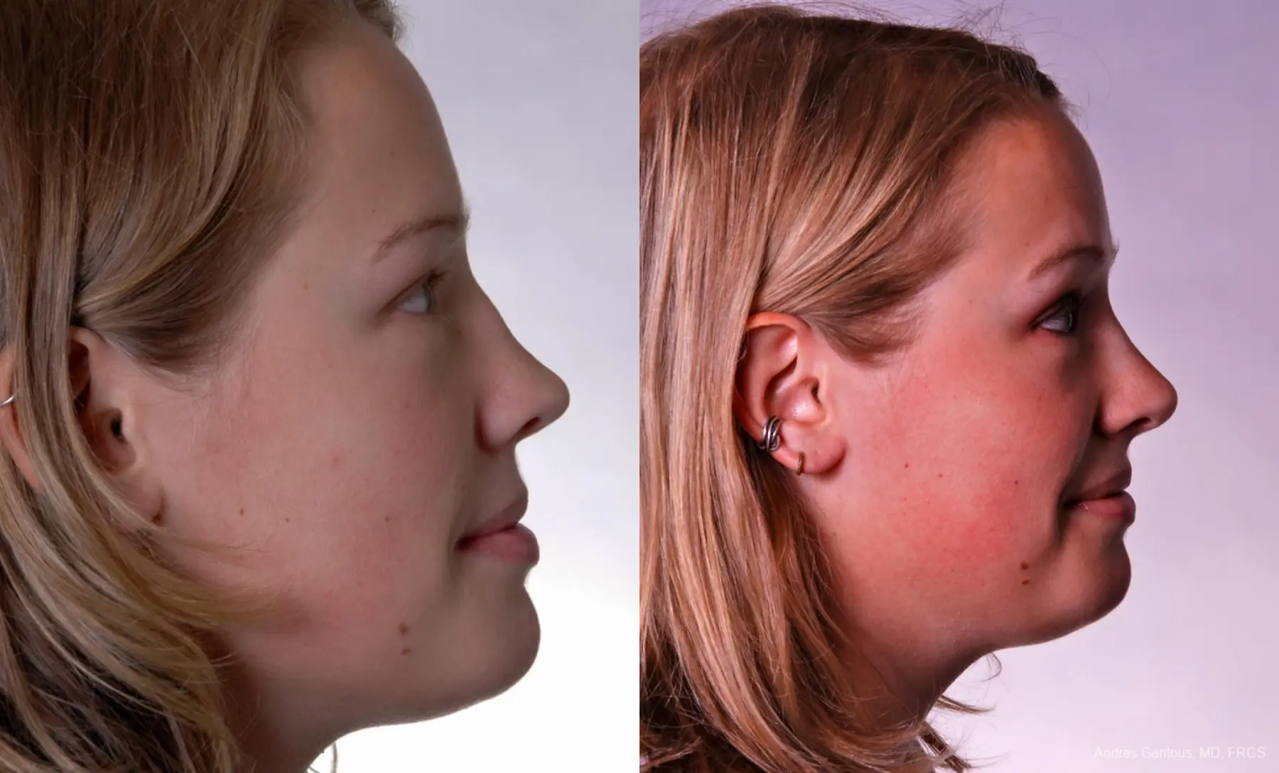 Reconstructive Rhinoplasty: Patient 3 - Before and After 4