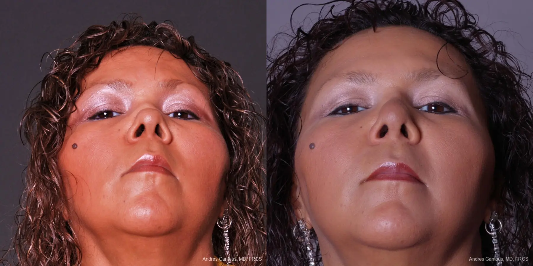 Reconstructive Rhinoplasty: Patient 1 - Before and After 4
