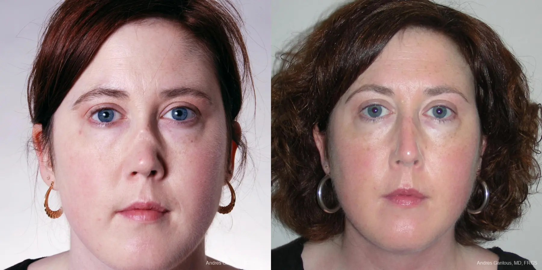 Reconstructive Rhinoplasty: Patient 2 - Before and After  