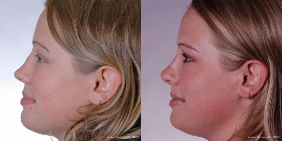 Reconstructive Rhinoplasty: Patient 3 - Before and After 3