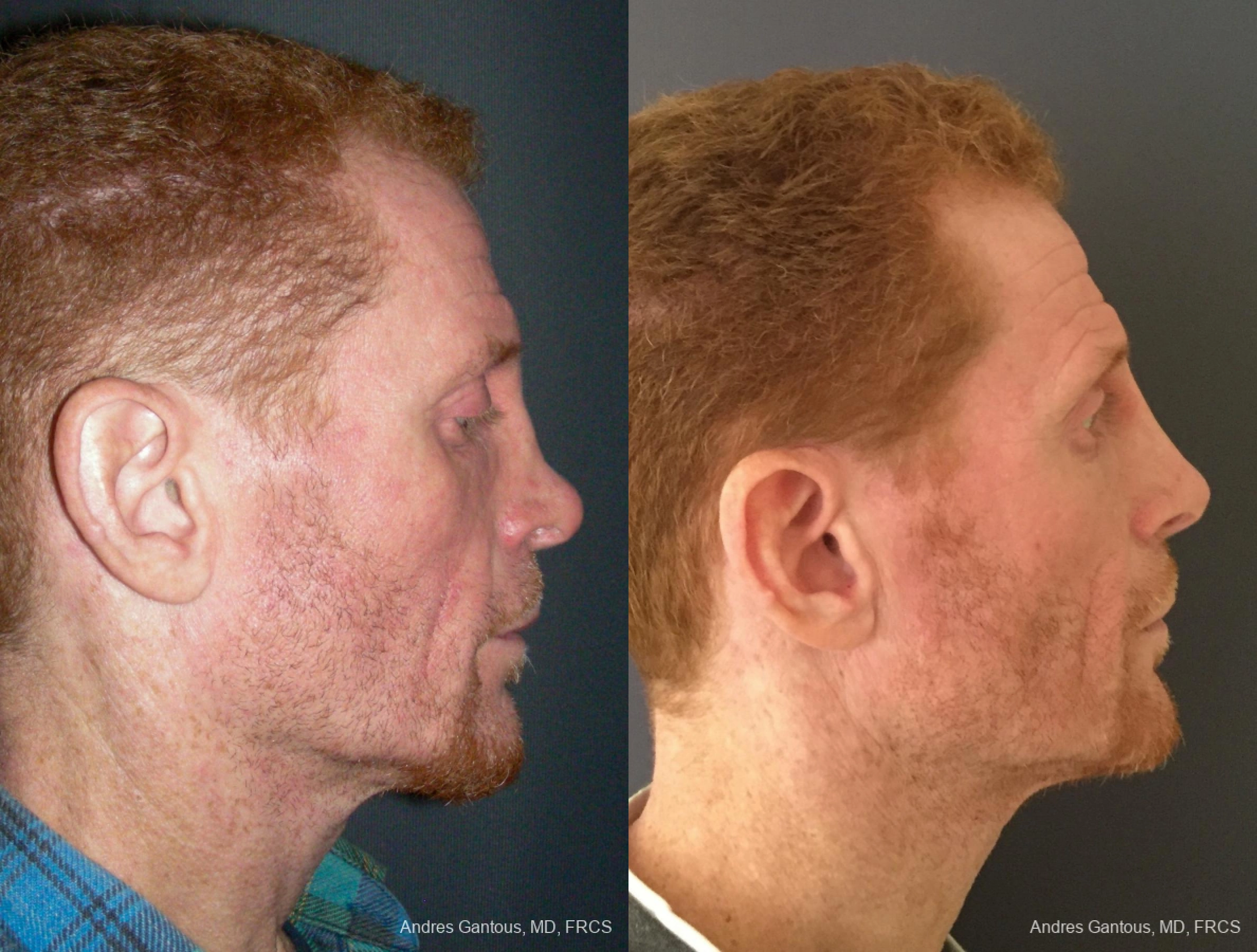 Reconstructive Rhinoplasty - Thumbnail 5