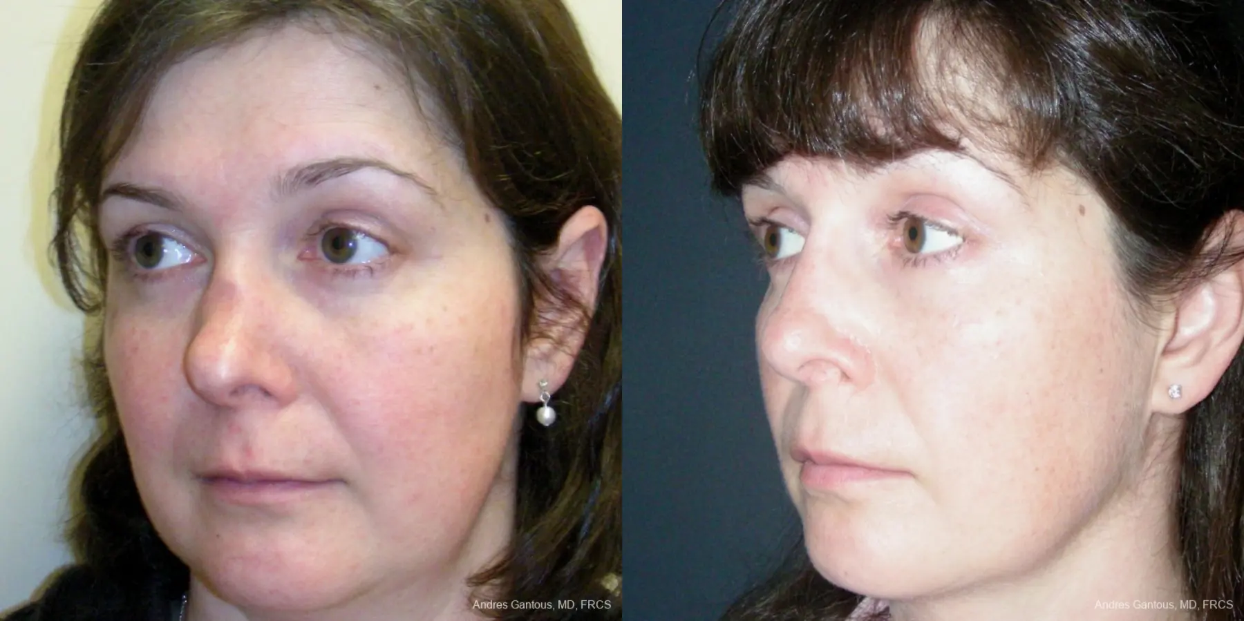 Reconstructive Rhinoplasty: Patient 5 - Before and After 4