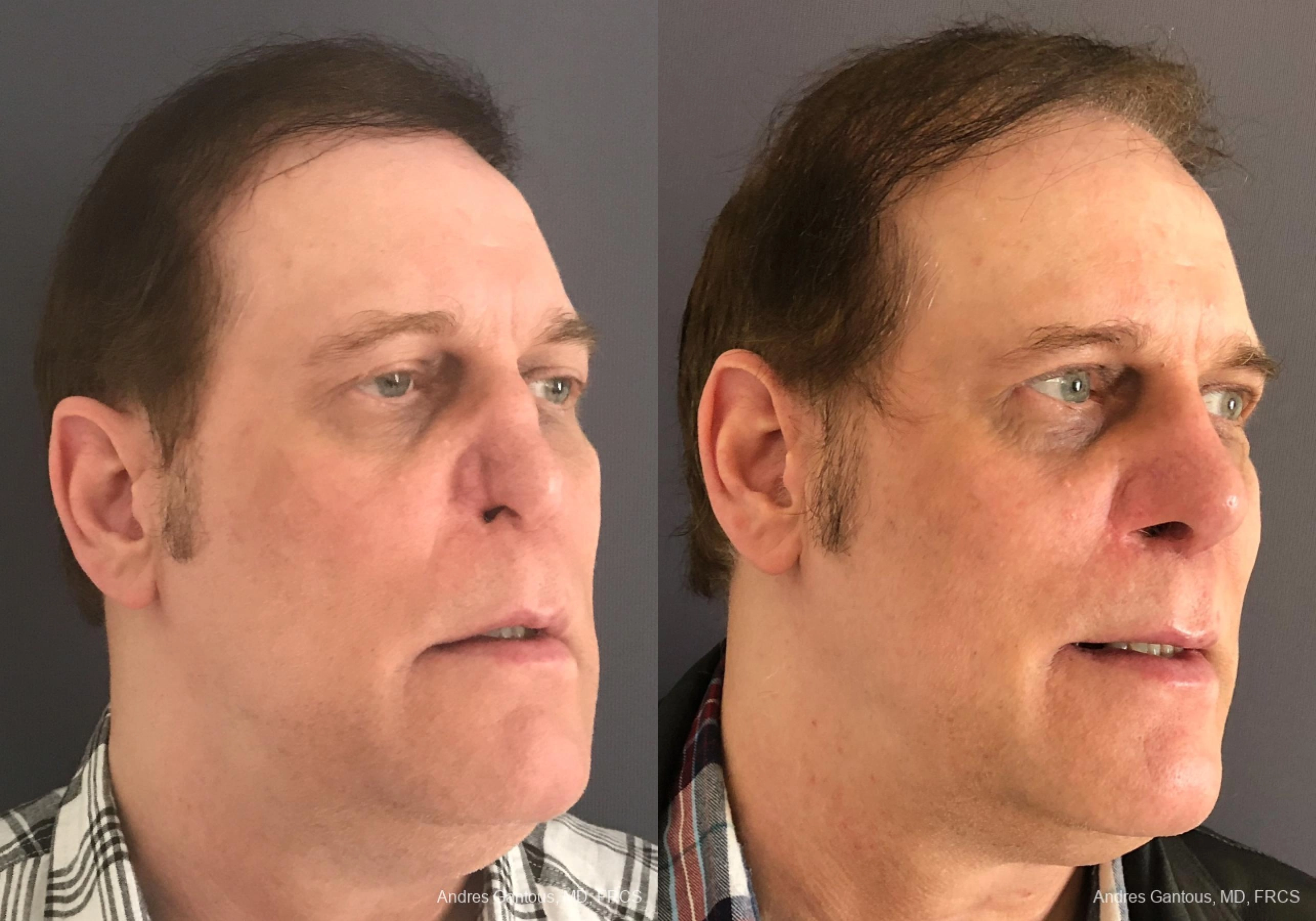 Reconstructive Rhinoplasty - Thumbnail 2