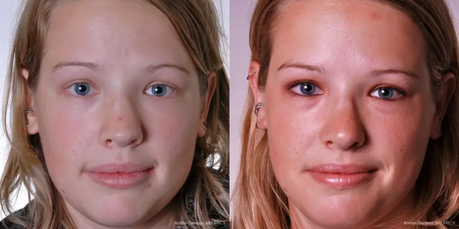 Reconstructive Rhinoplasty: Patient 3 - Before and After 1