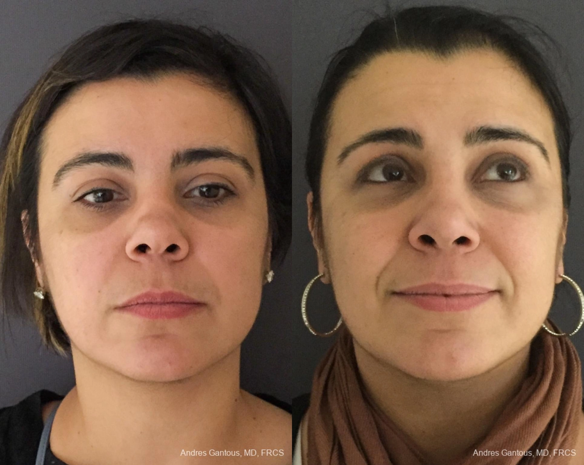 Reconstructive Rhinoplasty - Case 11755