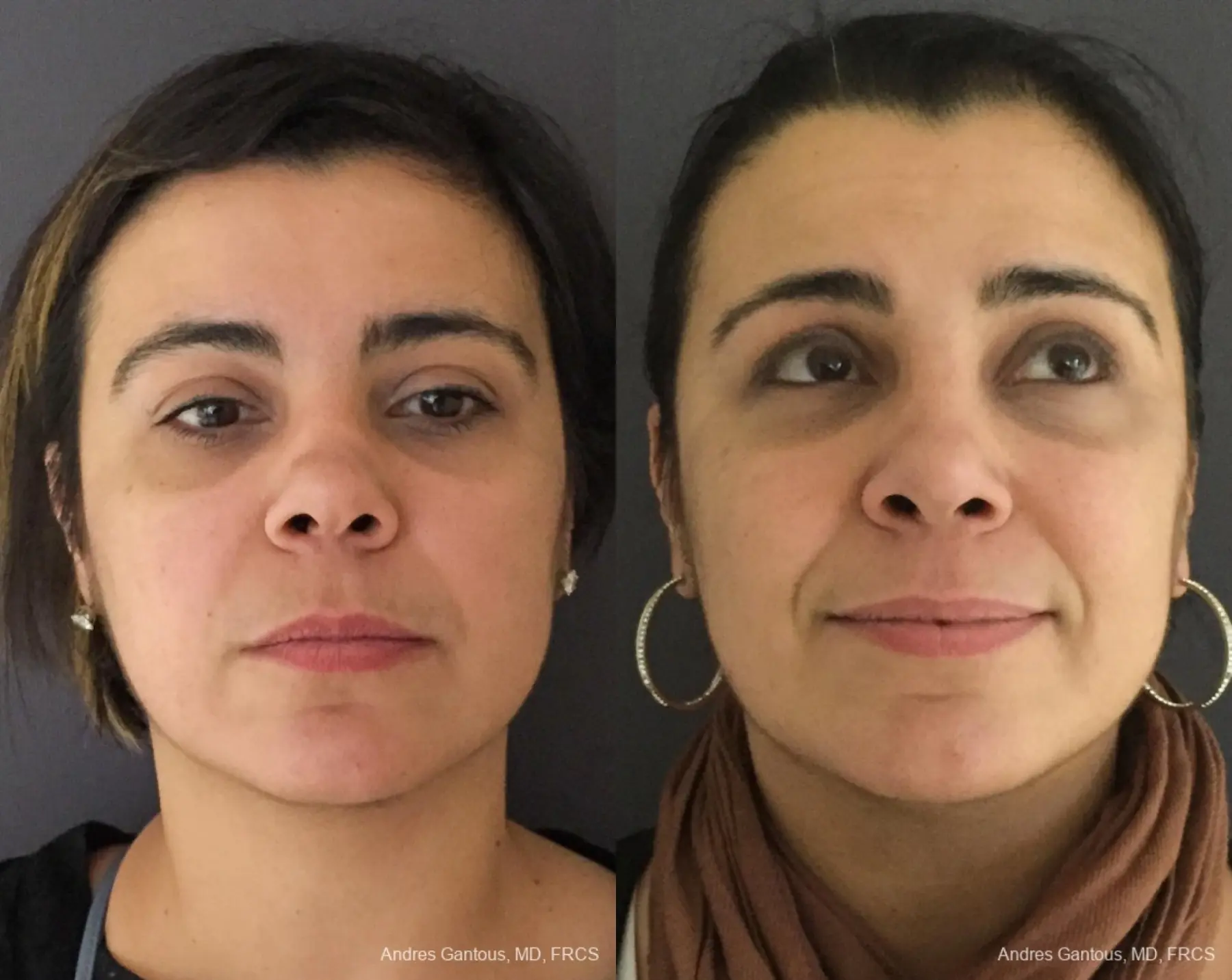 Reconstructive Rhinoplasty: Patient 11 - Before and After  