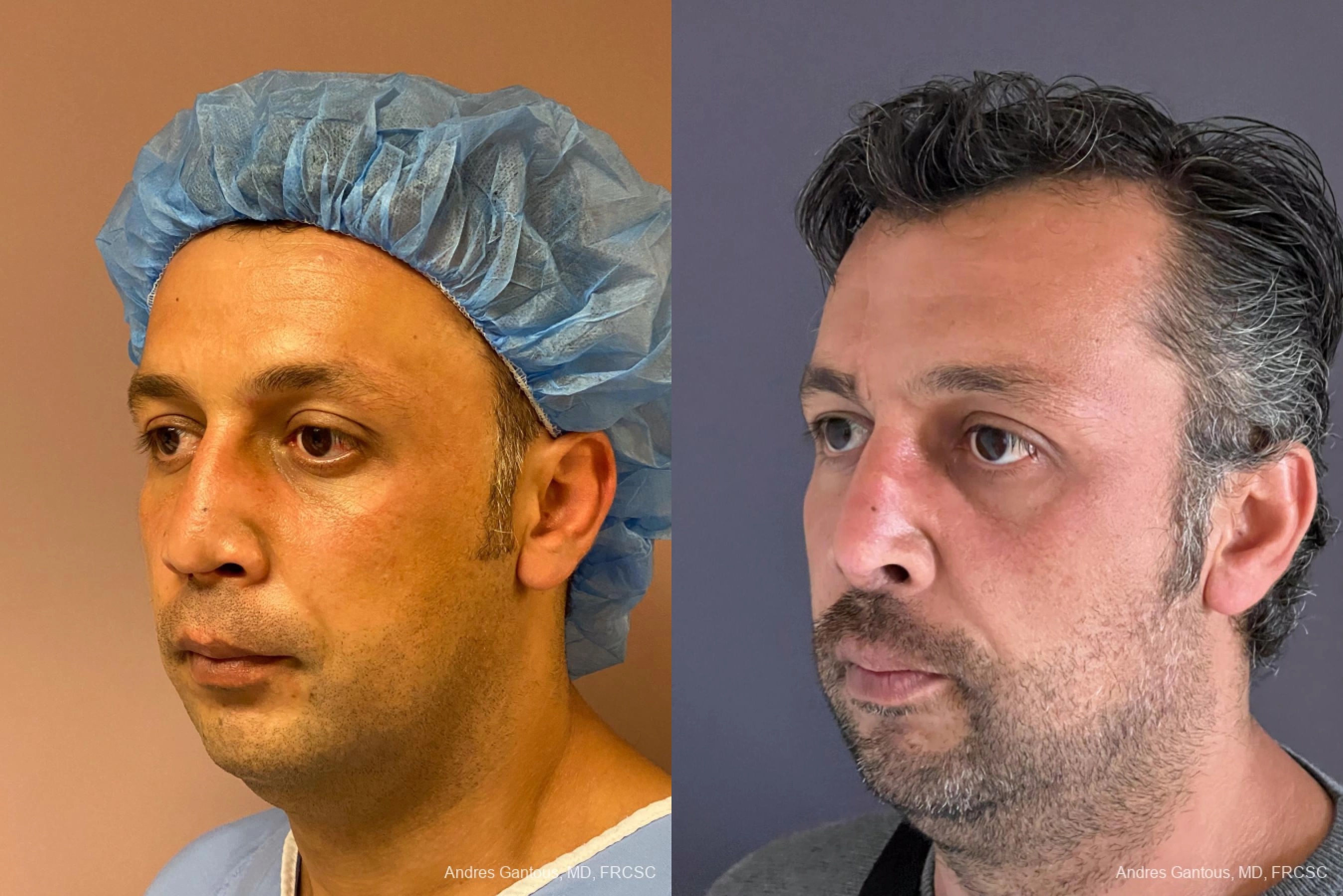 Reconstructive Rhinoplasty - Thumbnail 4