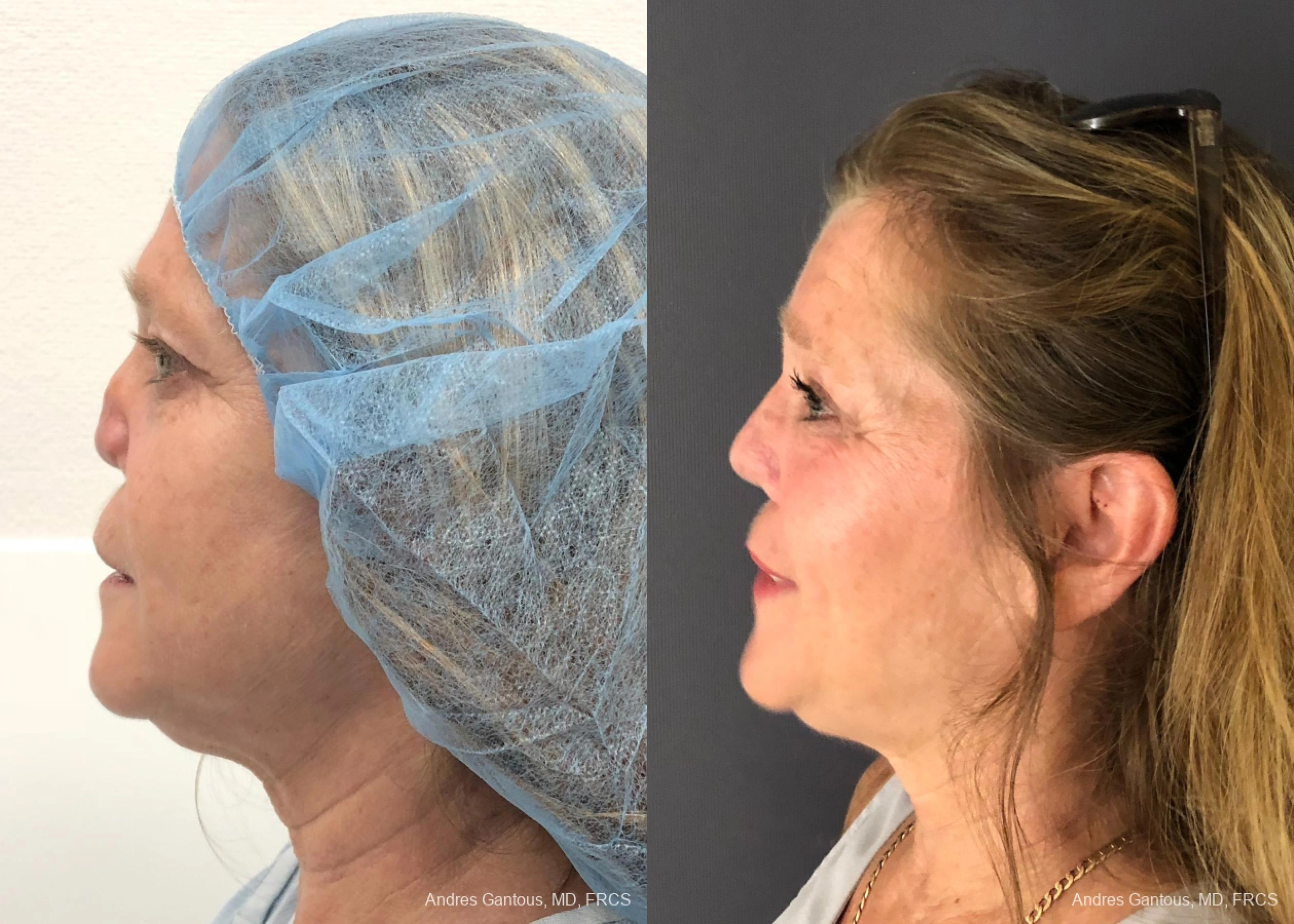 Reconstructive Rhinoplasty - Thumbnail 3