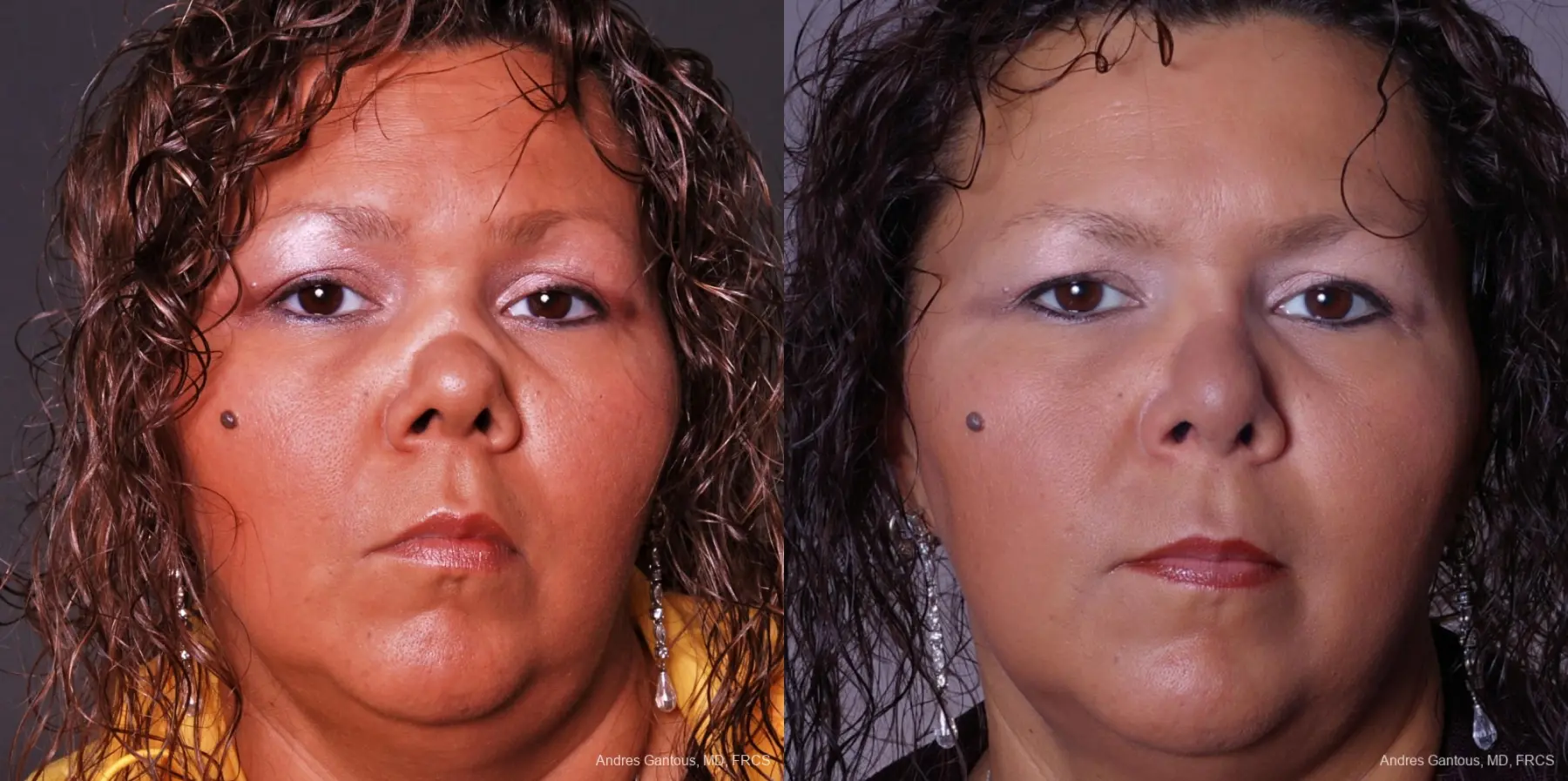 Reconstructive Rhinoplasty: Patient 1 - Before and After 1