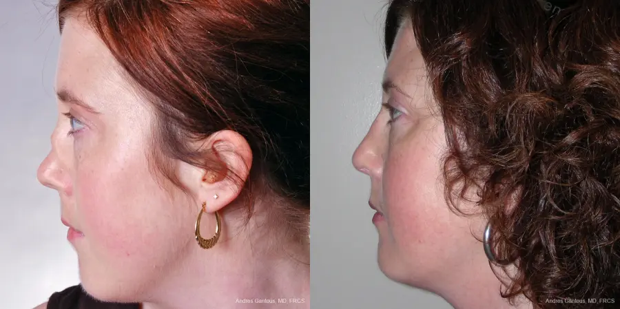 Reconstructive Rhinoplasty: Patient 2 - Before and After 3