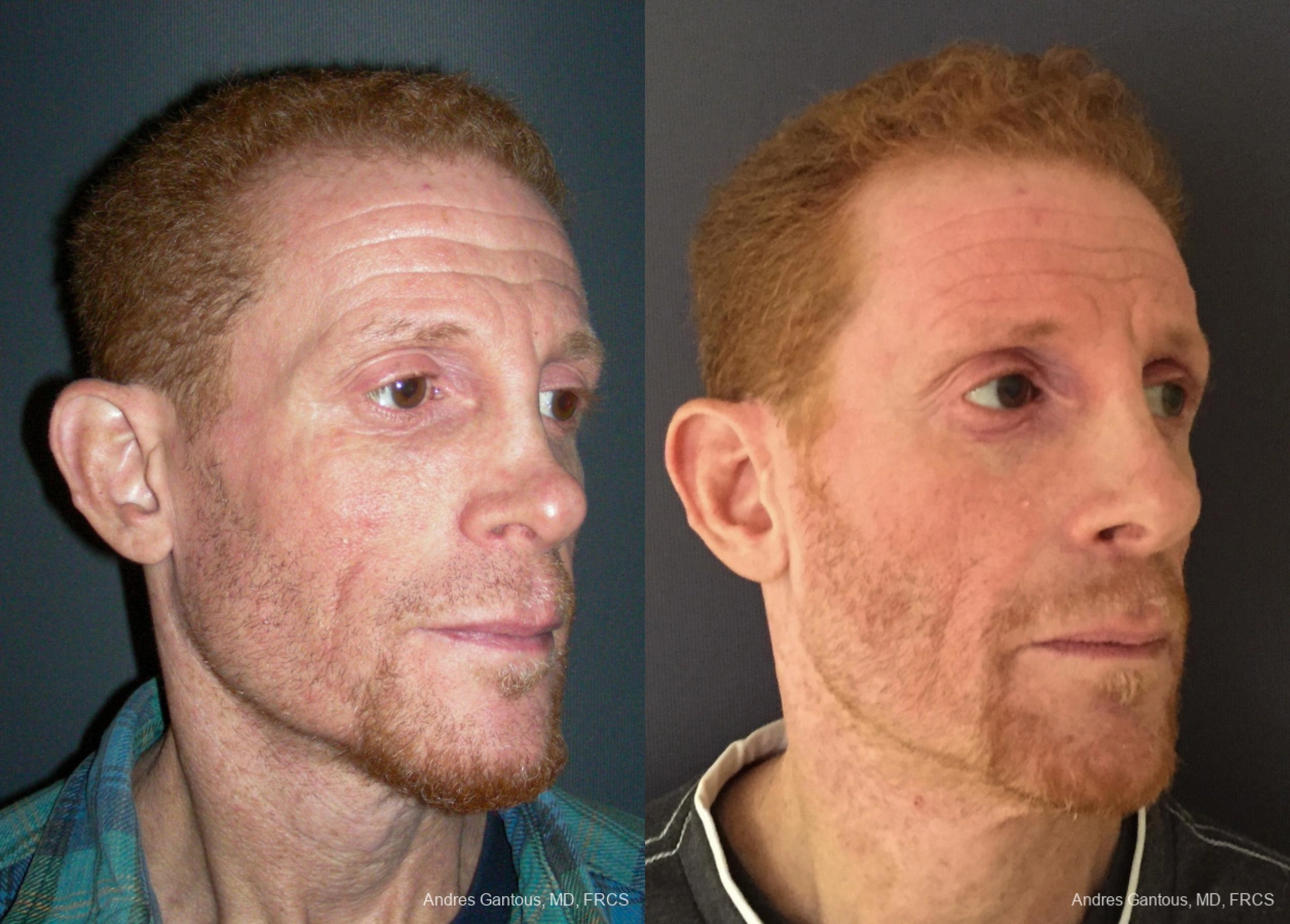 Reconstructive Rhinoplasty - Thumbnail 4