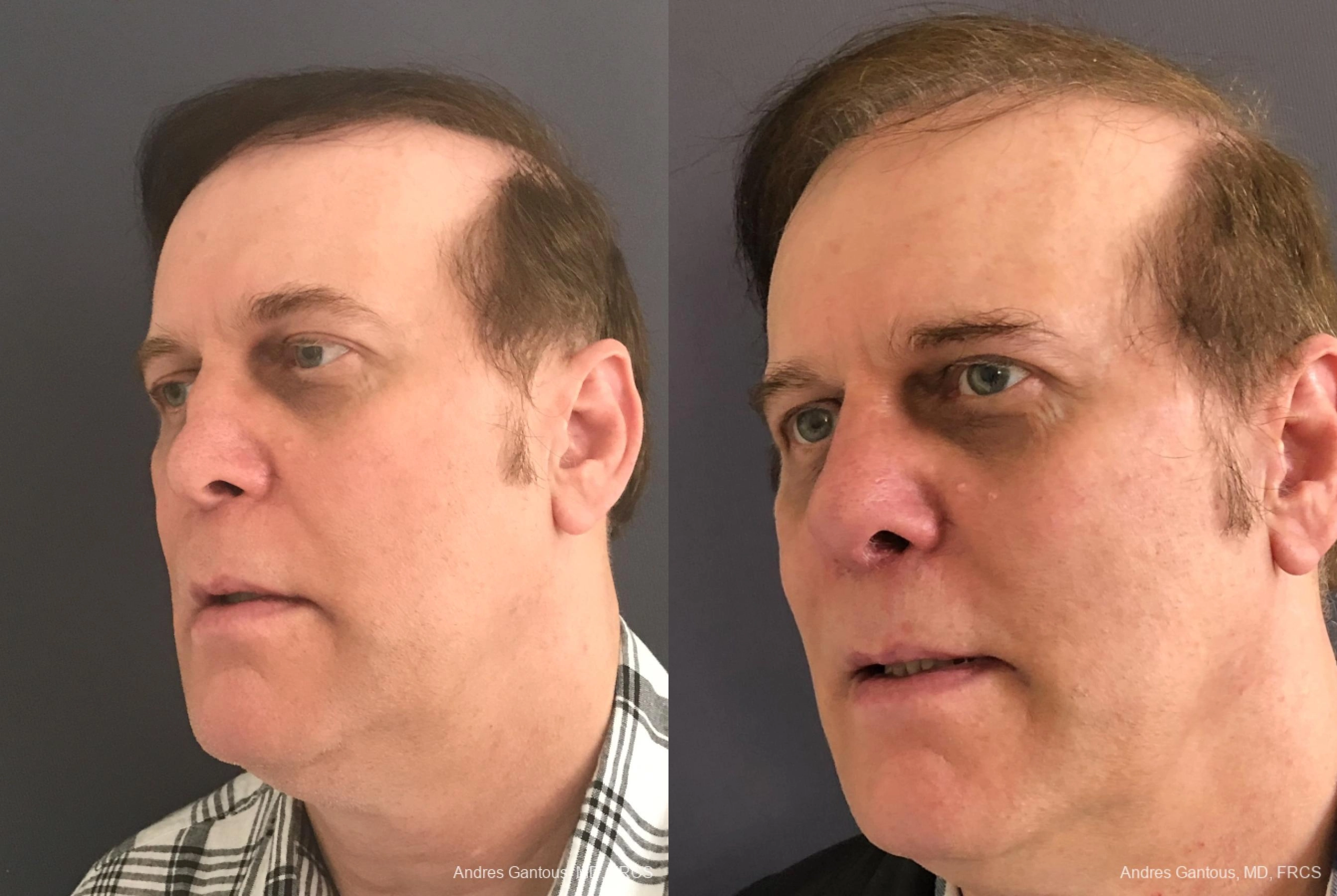 Reconstructive Rhinoplasty - Thumbnail 4