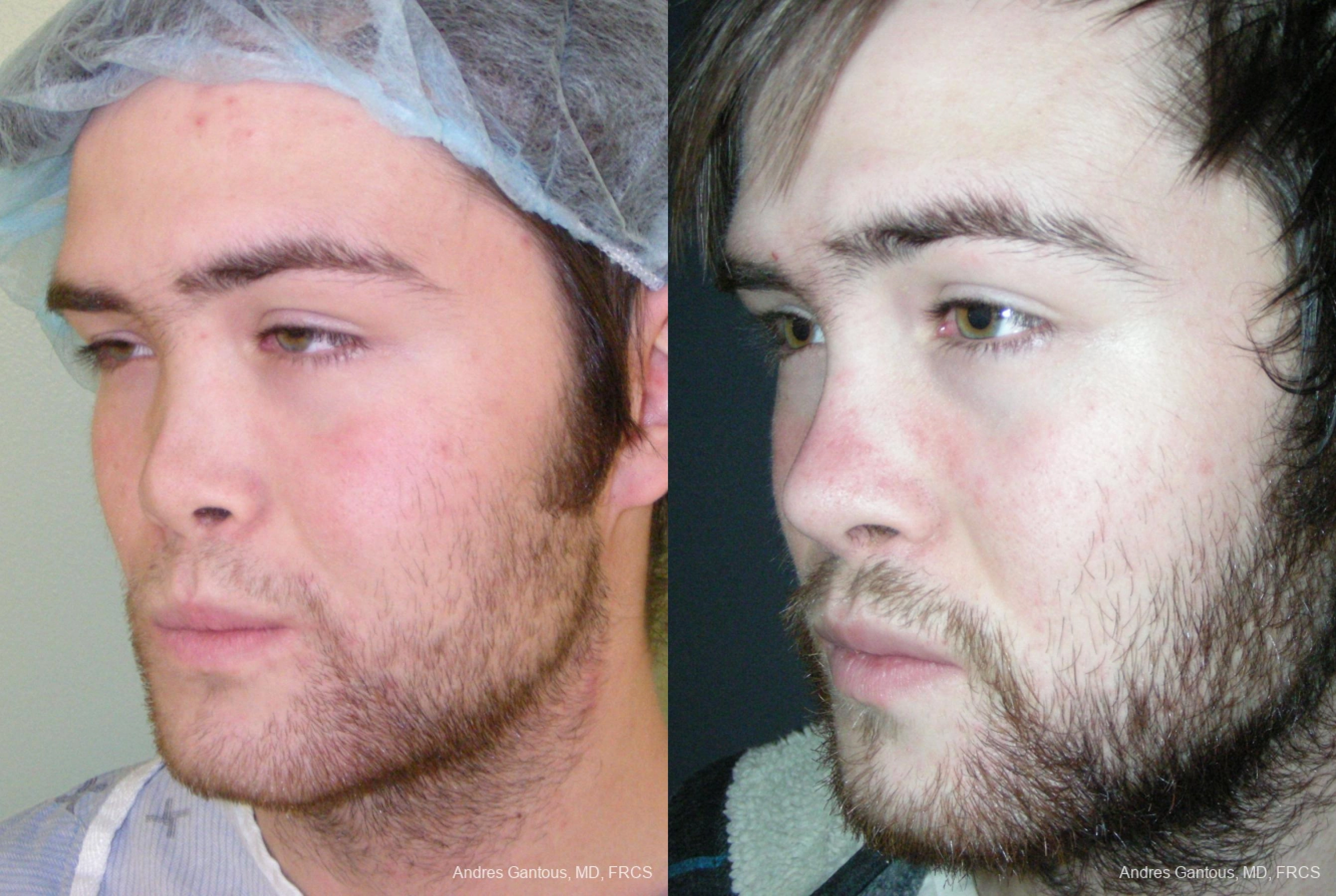 Reconstructive Rhinoplasty - Thumbnail 2