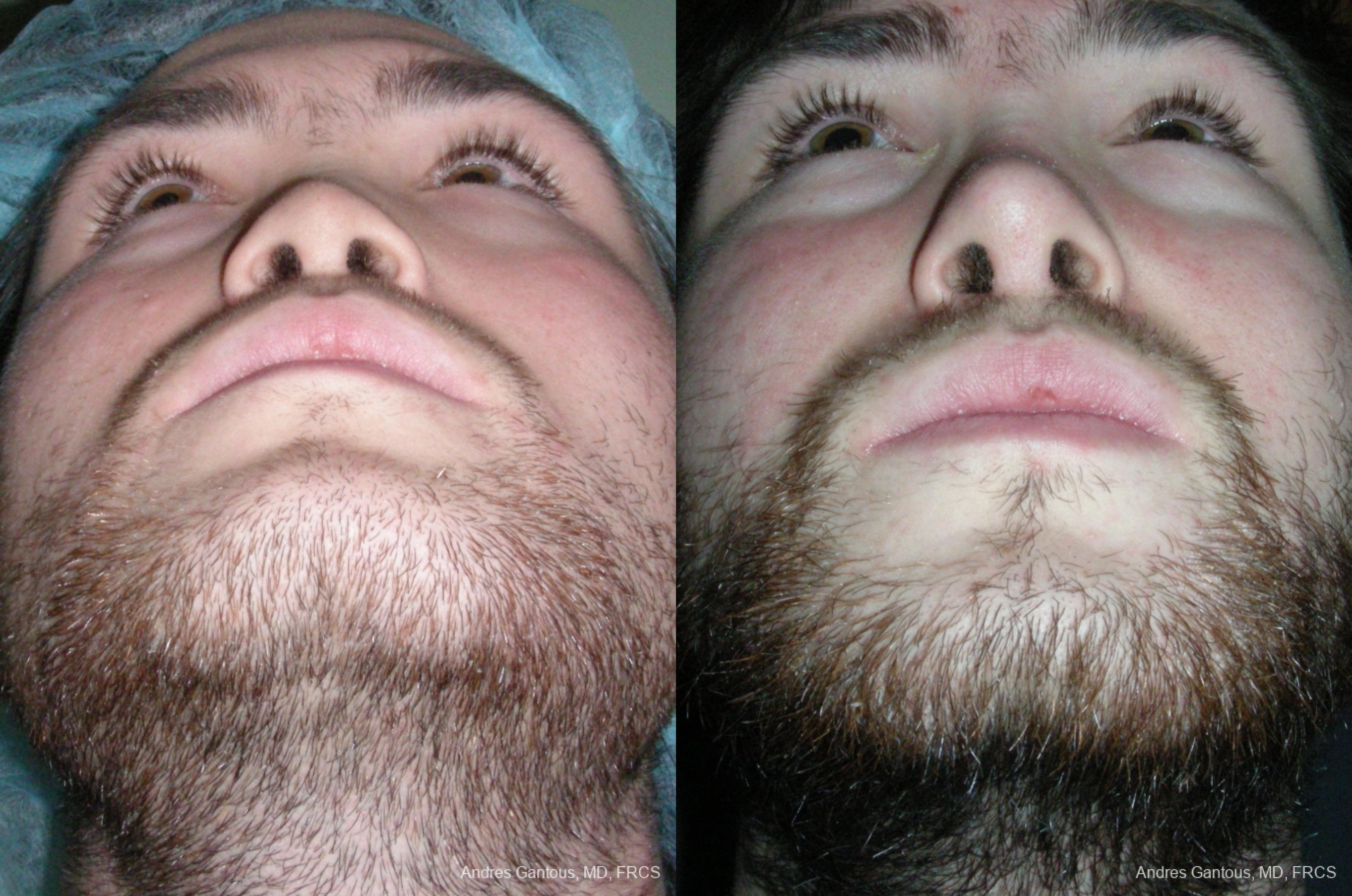 Reconstructive Rhinoplasty - Thumbnail 3