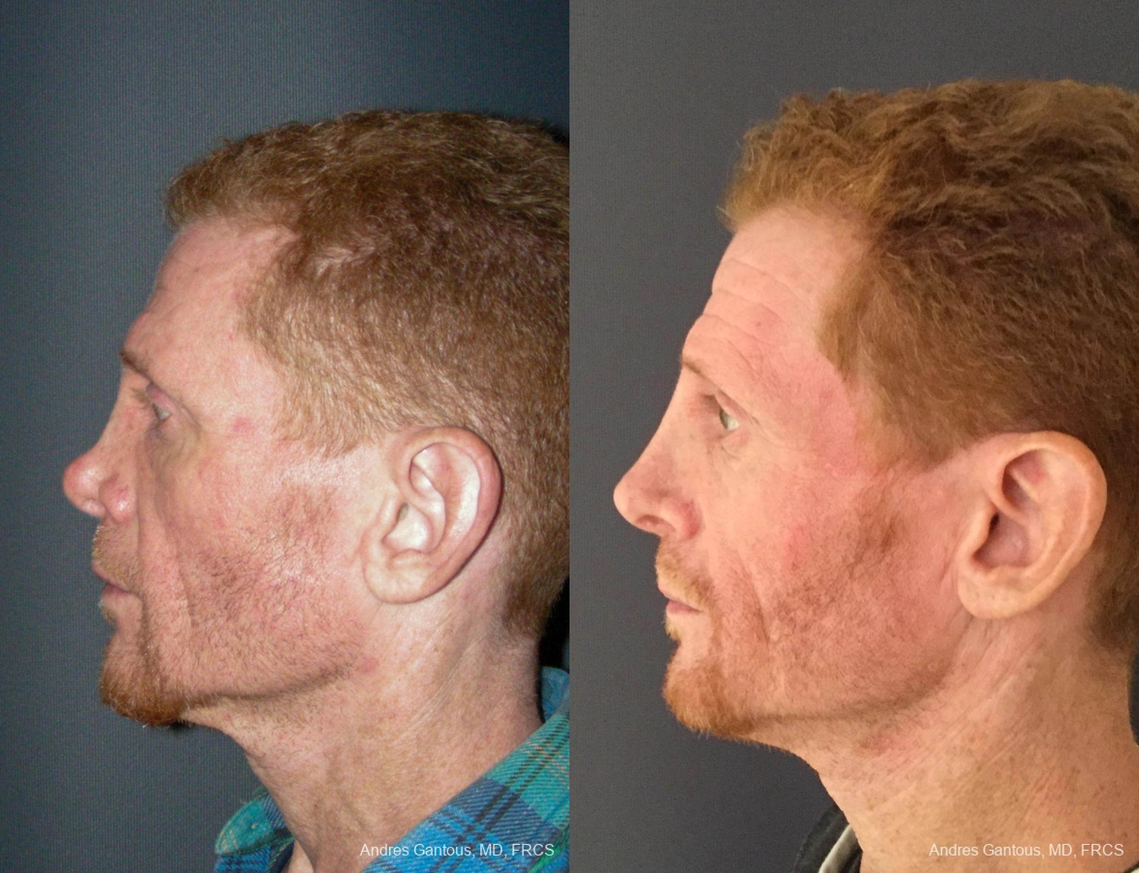 Reconstructive Rhinoplasty - Thumbnail 3