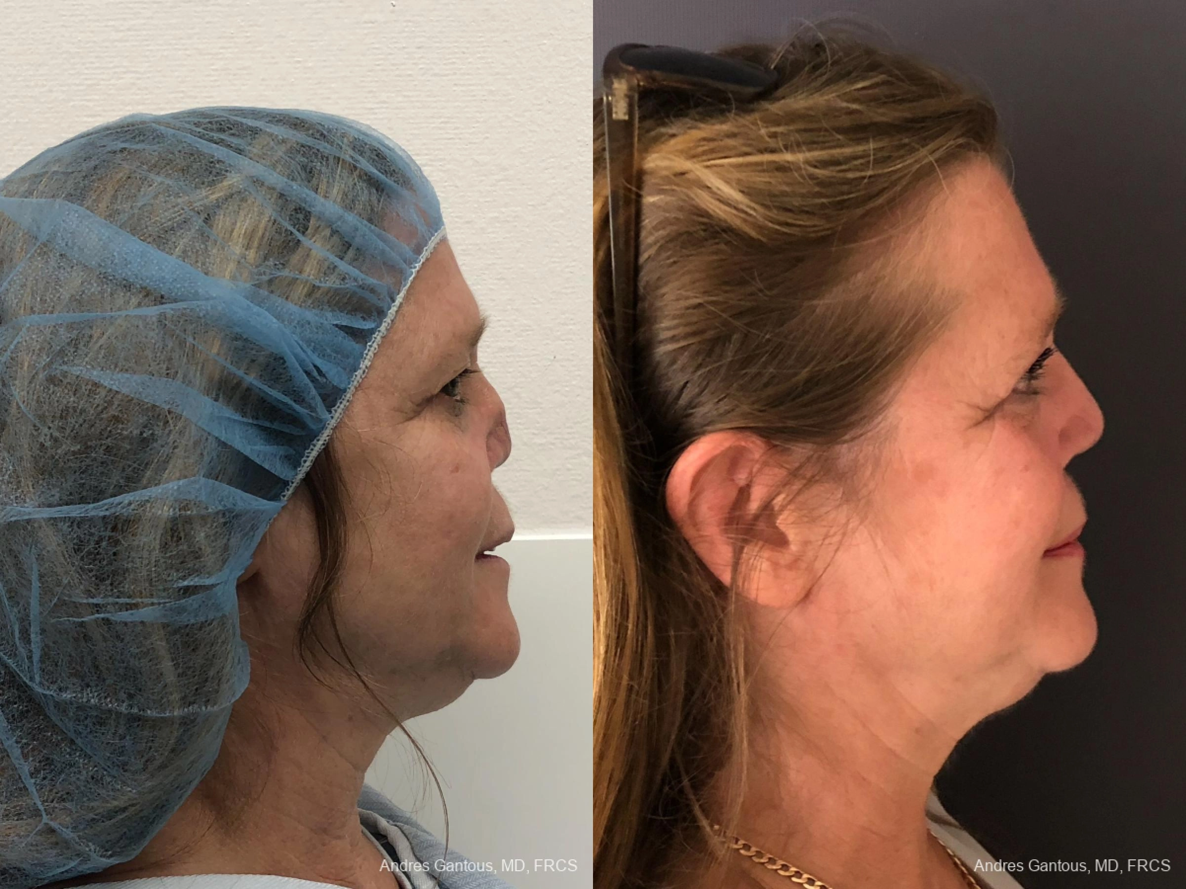 Reconstructive Rhinoplasty - Thumbnail 4