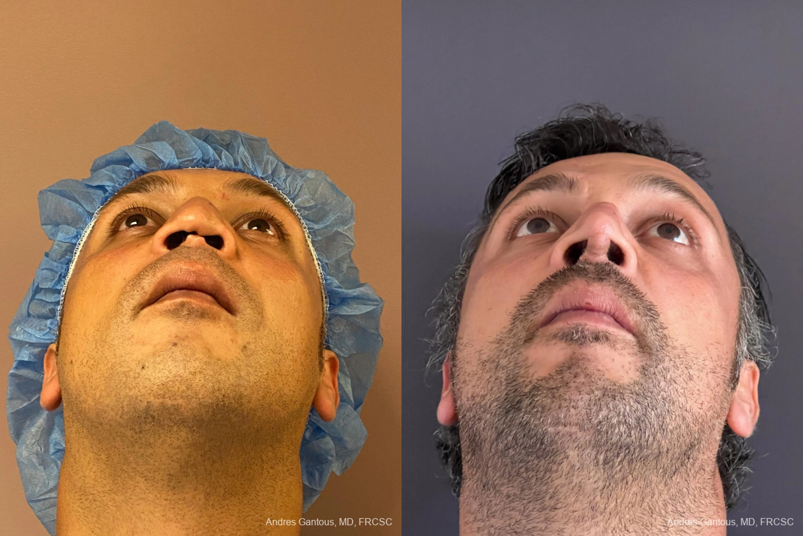 Reconstructive Rhinoplasty - Thumbnail 2