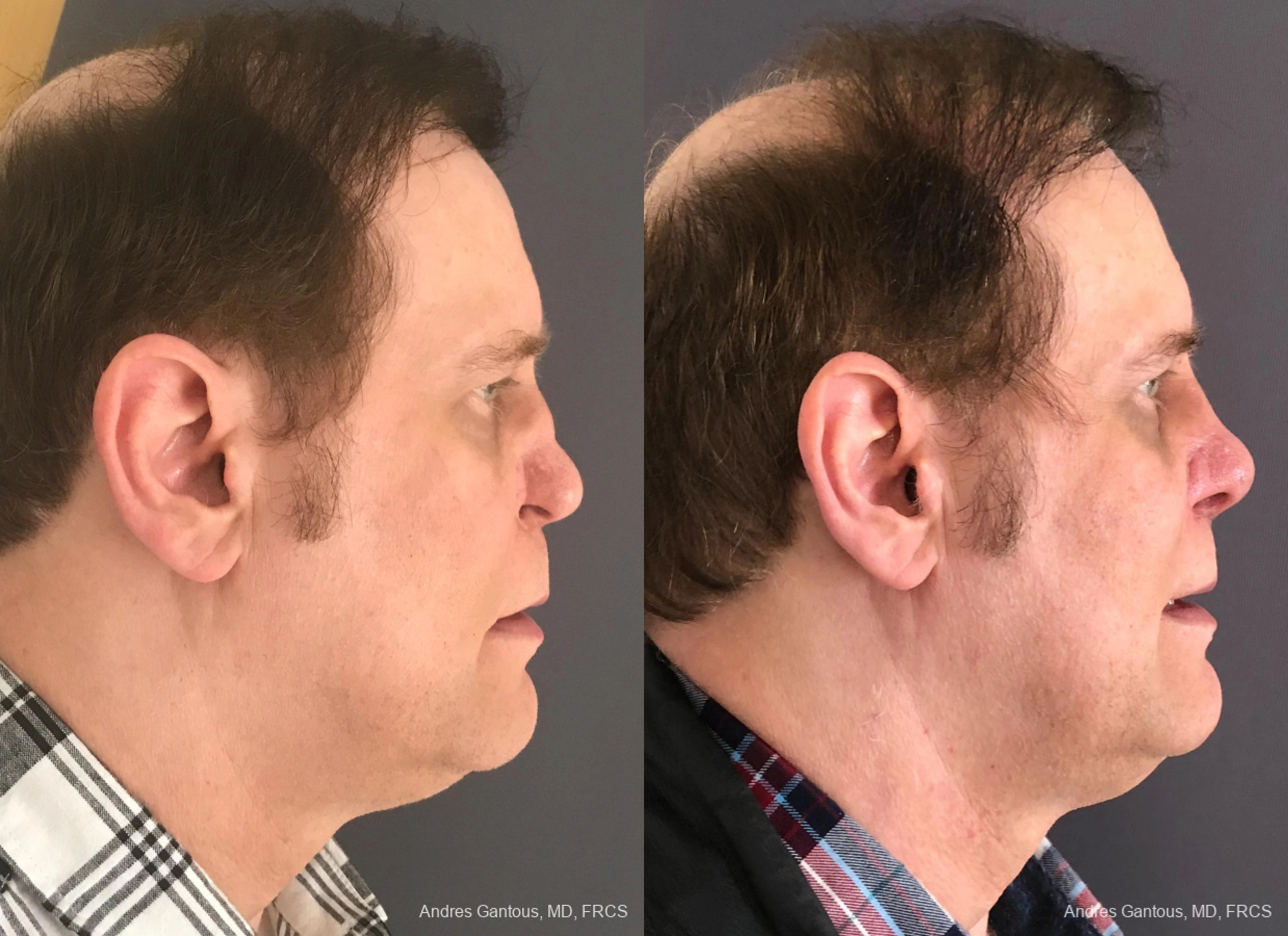 Reconstructive Rhinoplasty - Thumbnail 3