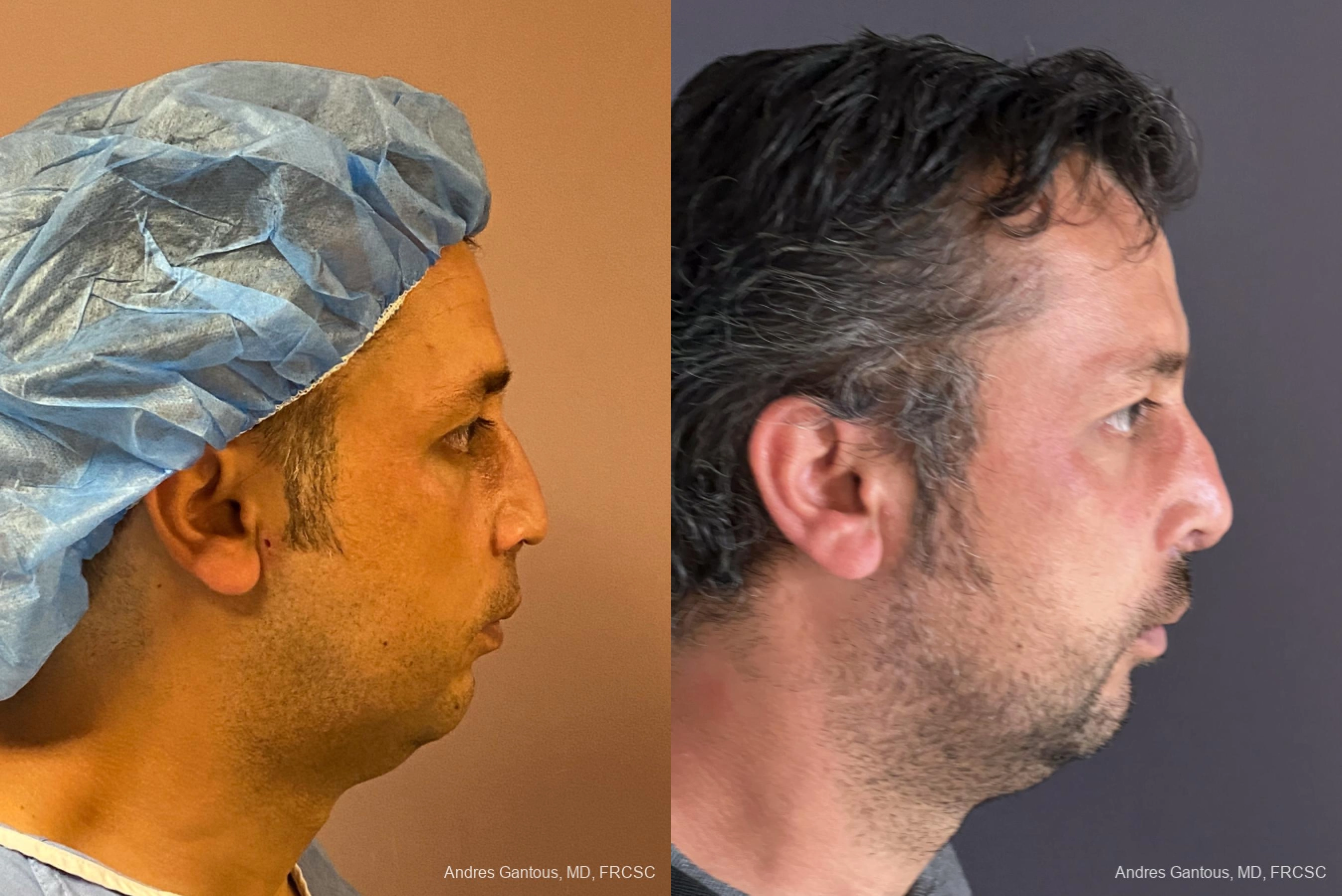 Reconstructive Rhinoplasty - Thumbnail 5