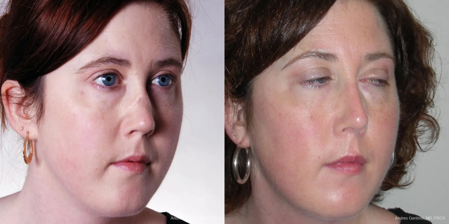 Reconstructive Rhinoplasty: Patient 2 - Before and After 4