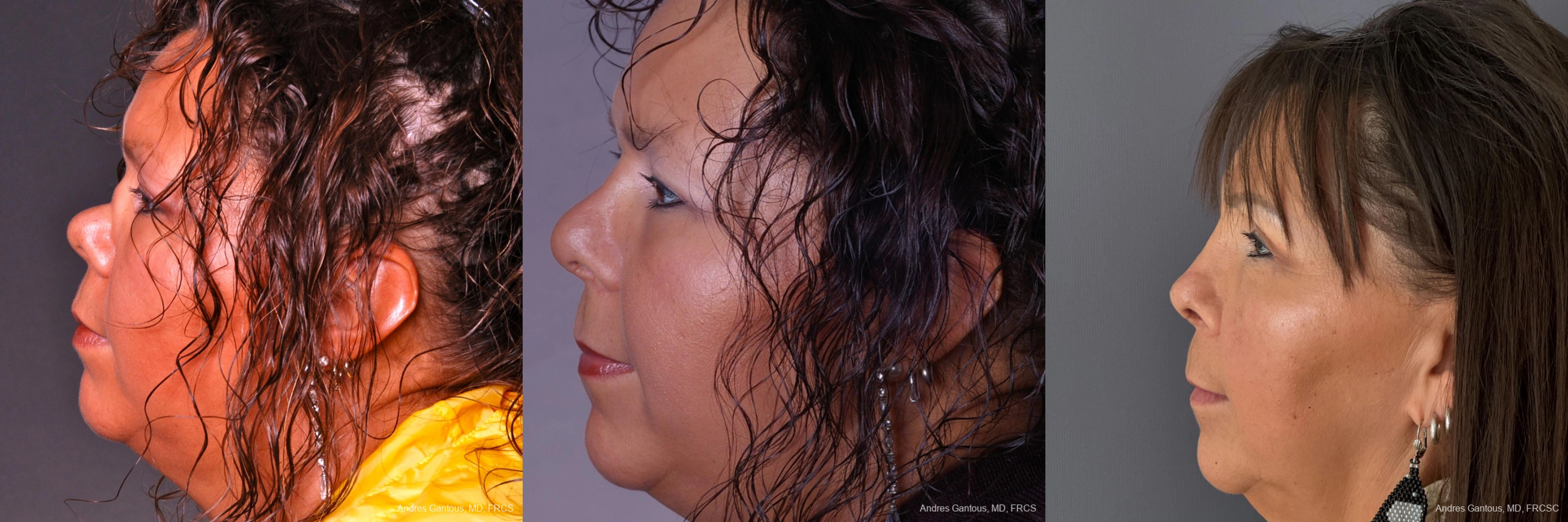 Reconstructive Rhinoplasty - Thumbnail 3