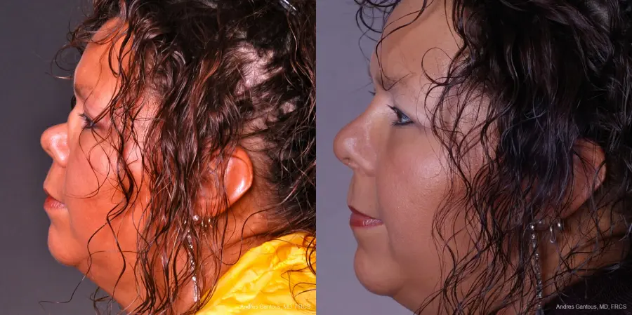 Reconstructive Rhinoplasty: Patient 1 - Before and After 3