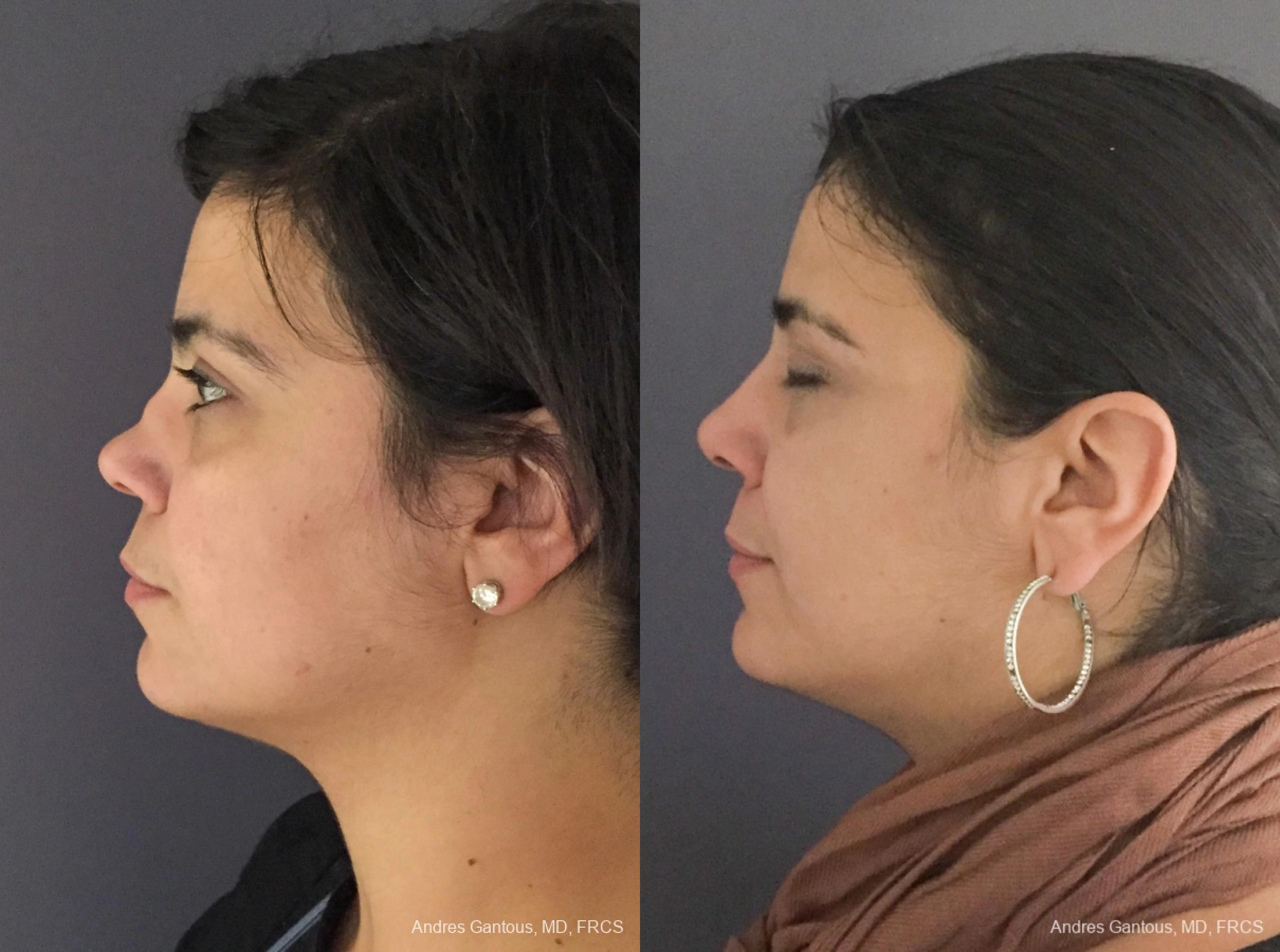 Reconstructive Rhinoplasty - Thumbnail 2