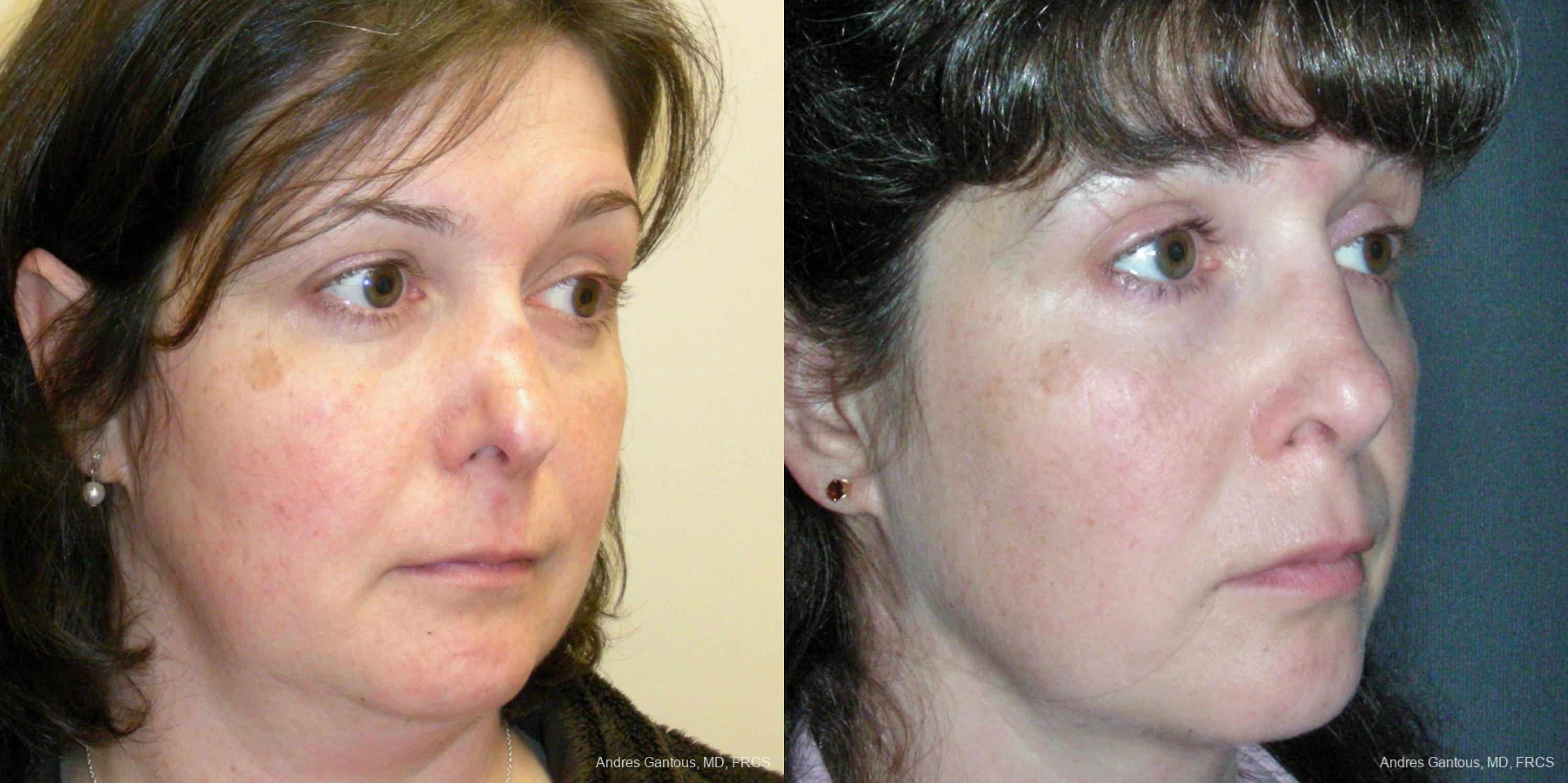 Reconstructive Rhinoplasty - Thumbnail 2